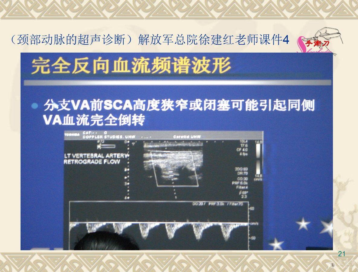 鎖骨下動脈竊血綜合徵超聲診斷圖解