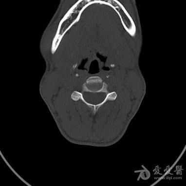 舌骨CT图片
