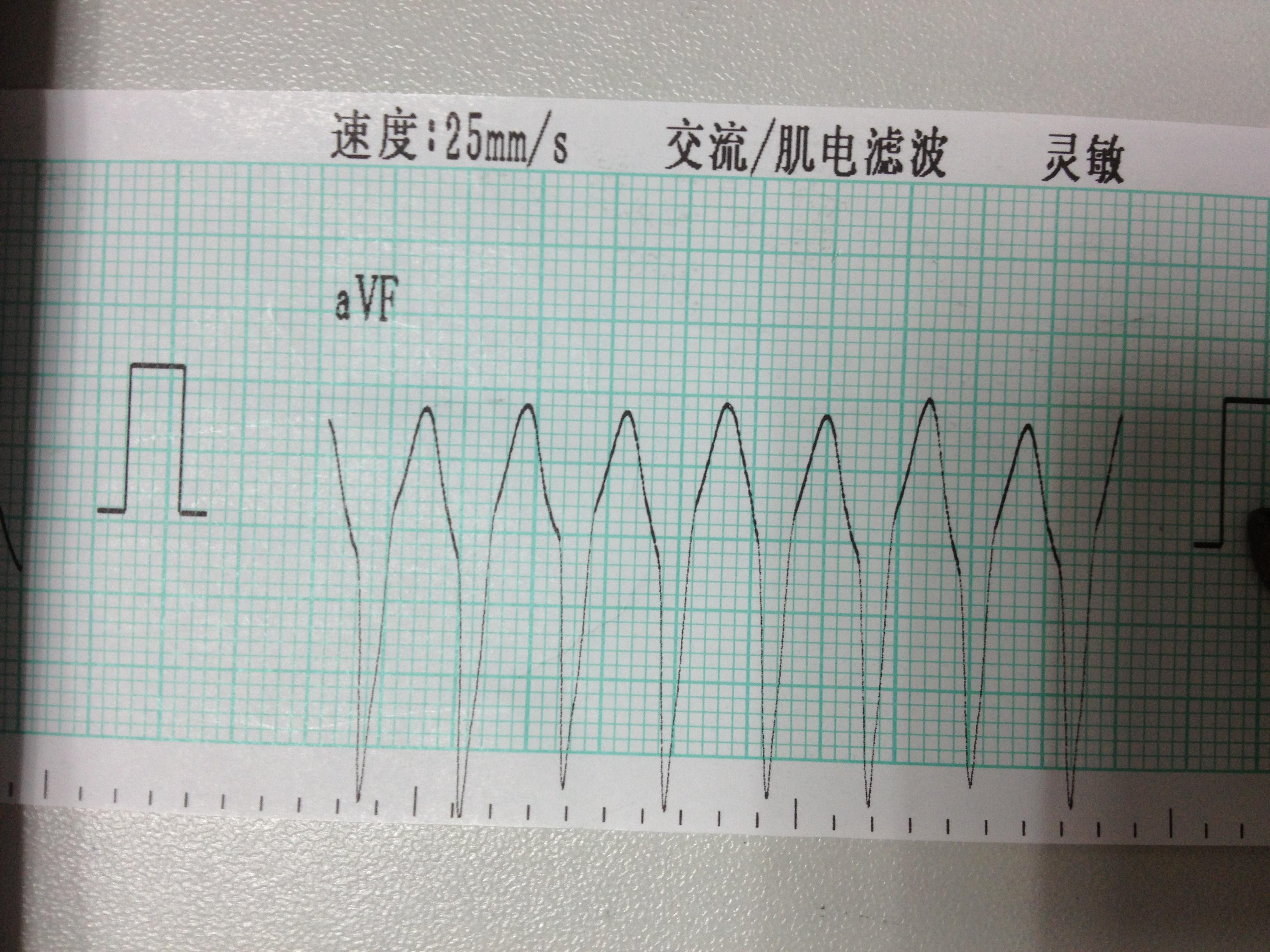 极速型室性心动过速已贴转窦律心电图