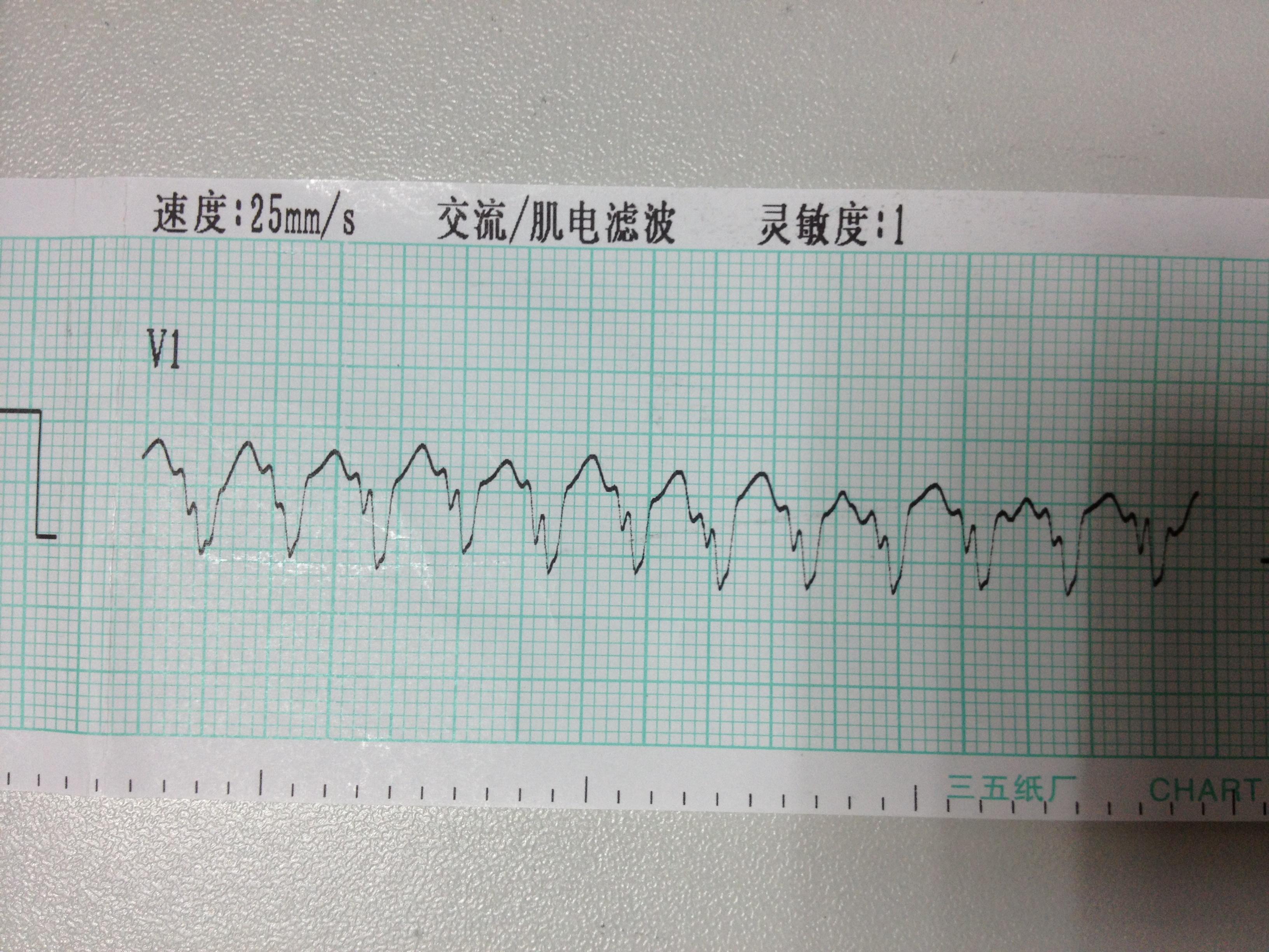 極速型室性心動過速已貼轉竇律心電圖