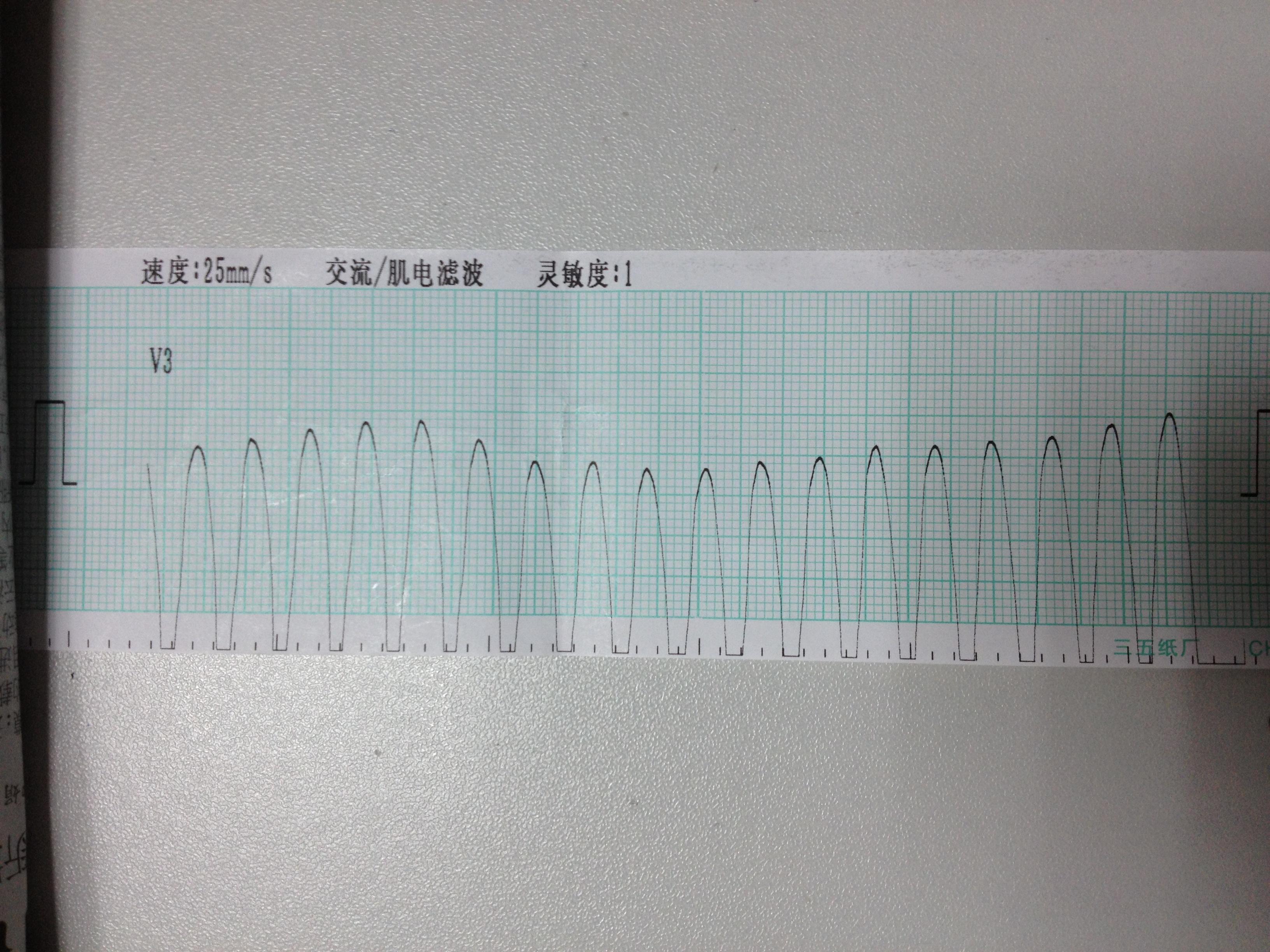 极速型室性心动过速已贴转窦律心电图
