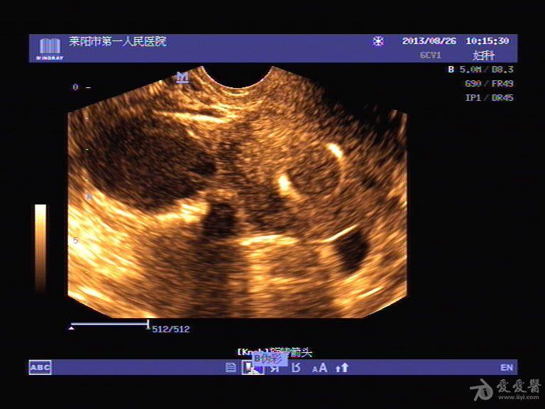 超聲入門貼142巧克力囊腫經腹經陰超聲圖比對