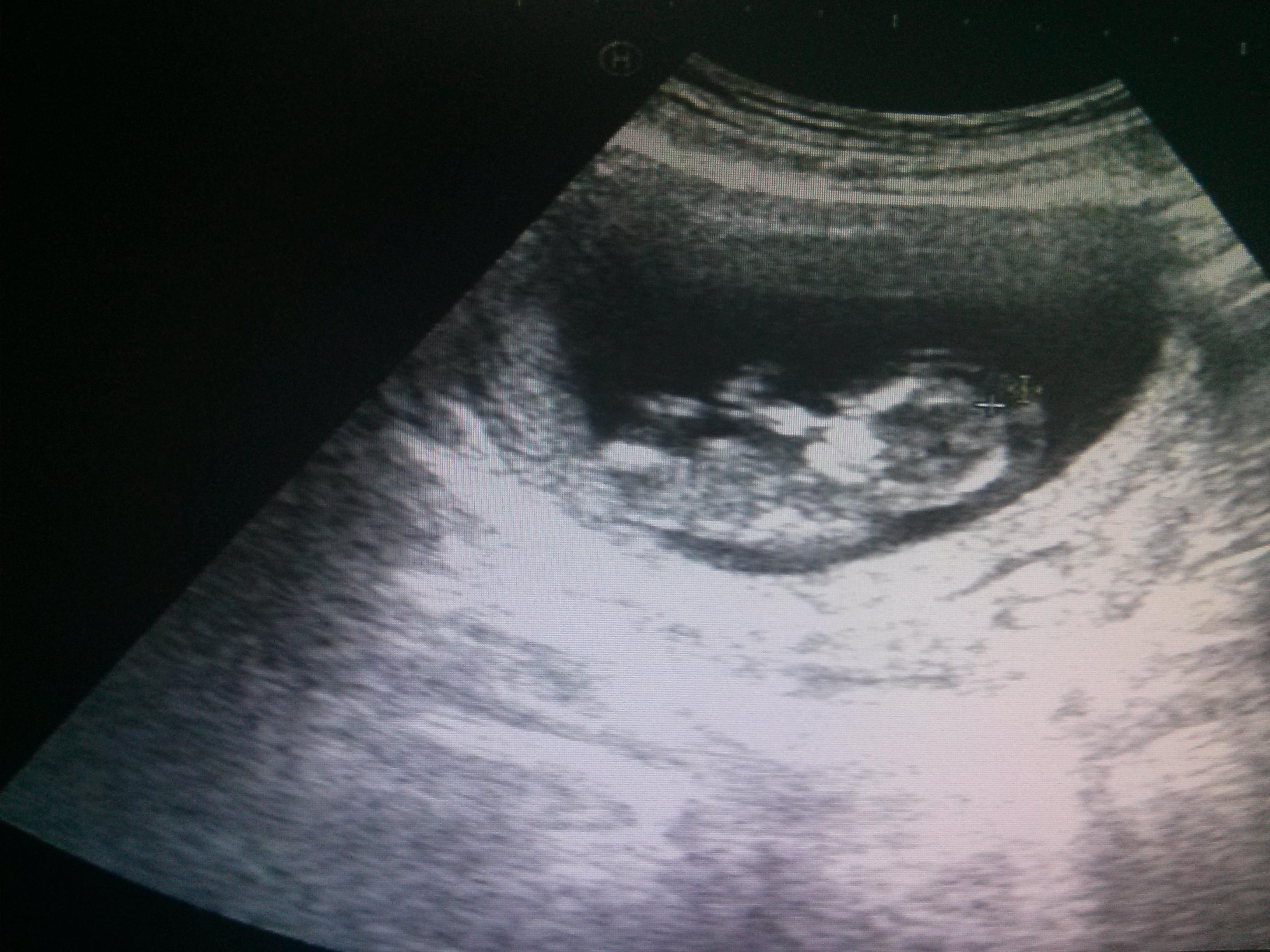 这是水囊样淋巴管瘤吗