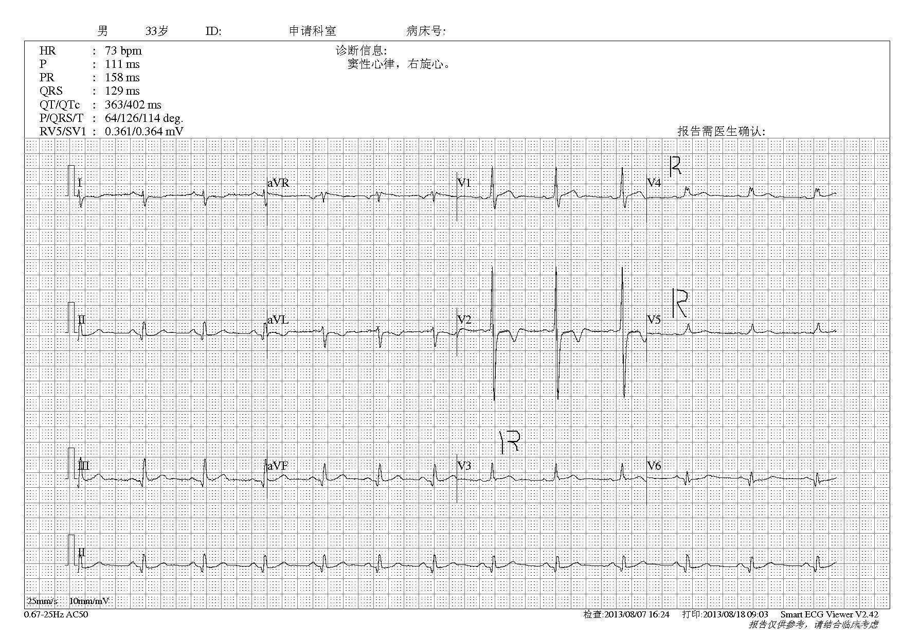心电图简谱_正常心电图图片(2)