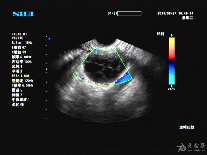 黄体囊肿超声声像图图片