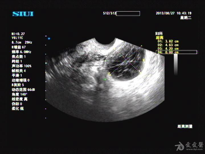 黄体囊肿还是黄素囊肿呢