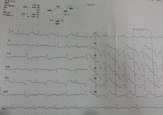 房顫復律後低鉀出現少見心電圖一例請大家指教