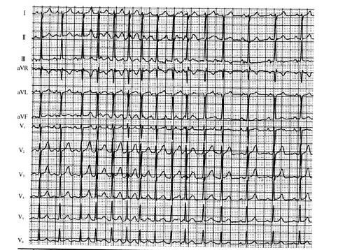 卢喜烈教你分析心电图:房性心动过速系列病例