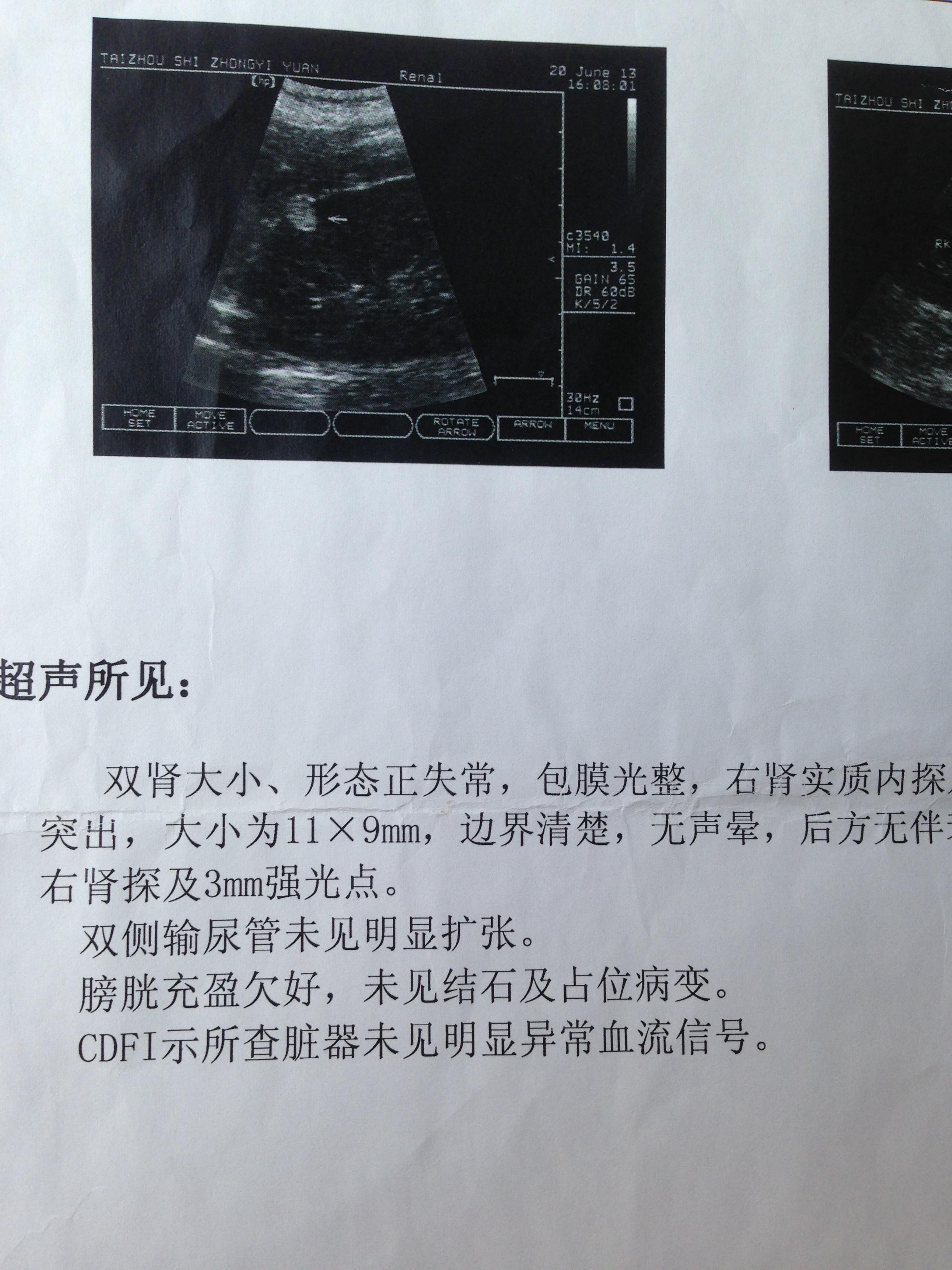 肾脏有占位求解各位医生图已上传