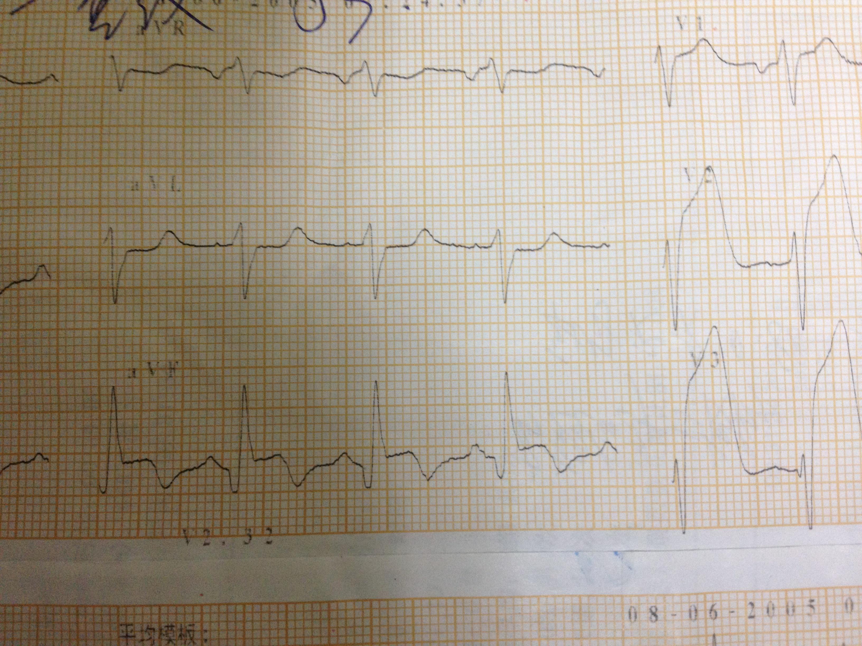 广泛性前壁心肌梗阻欣赏 心电图脑电图专业讨论版 爱爱医医学论坛