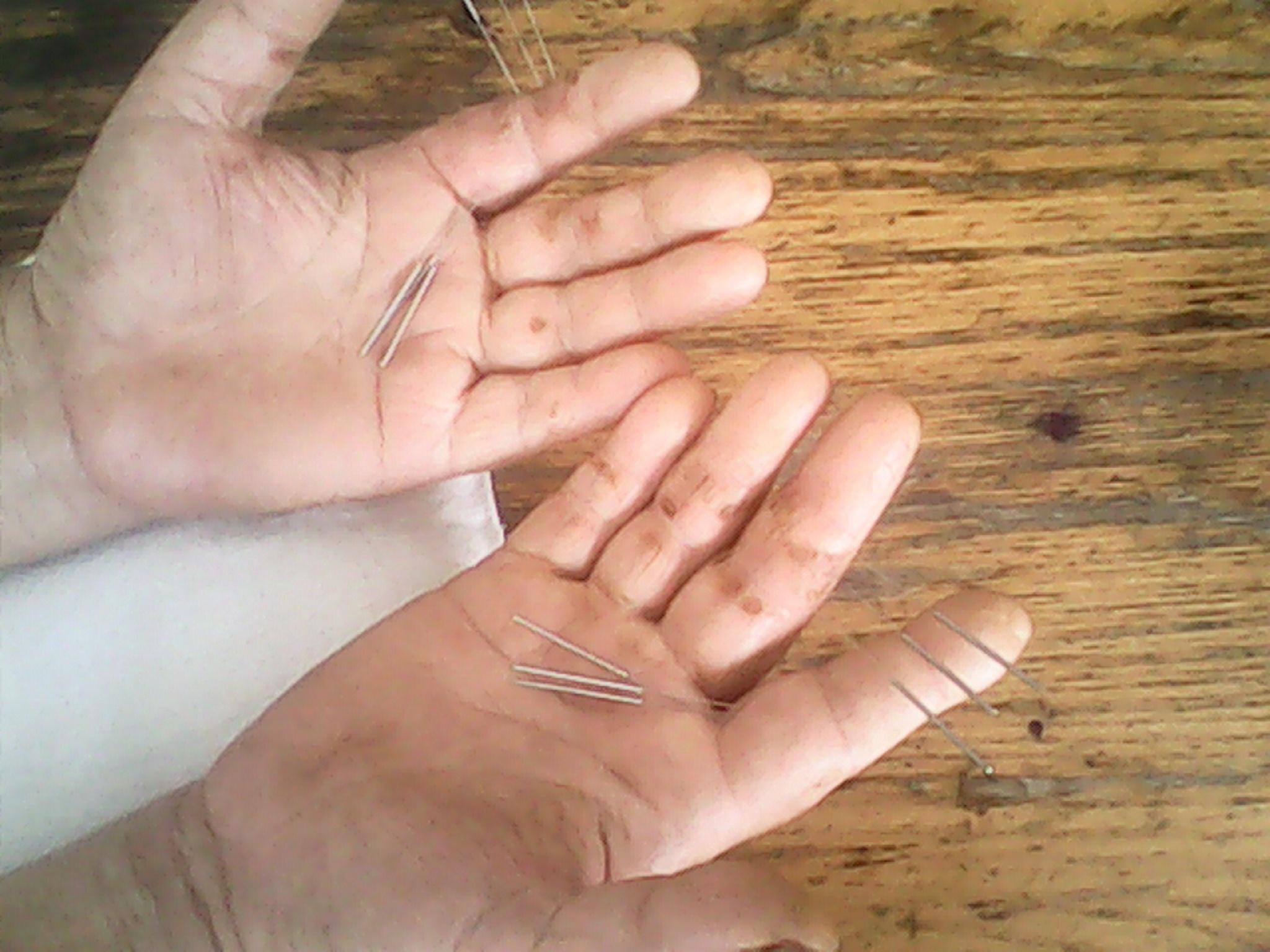 董氏奇穴治疗手掌干裂脱皮十年病史有图大家探讨下