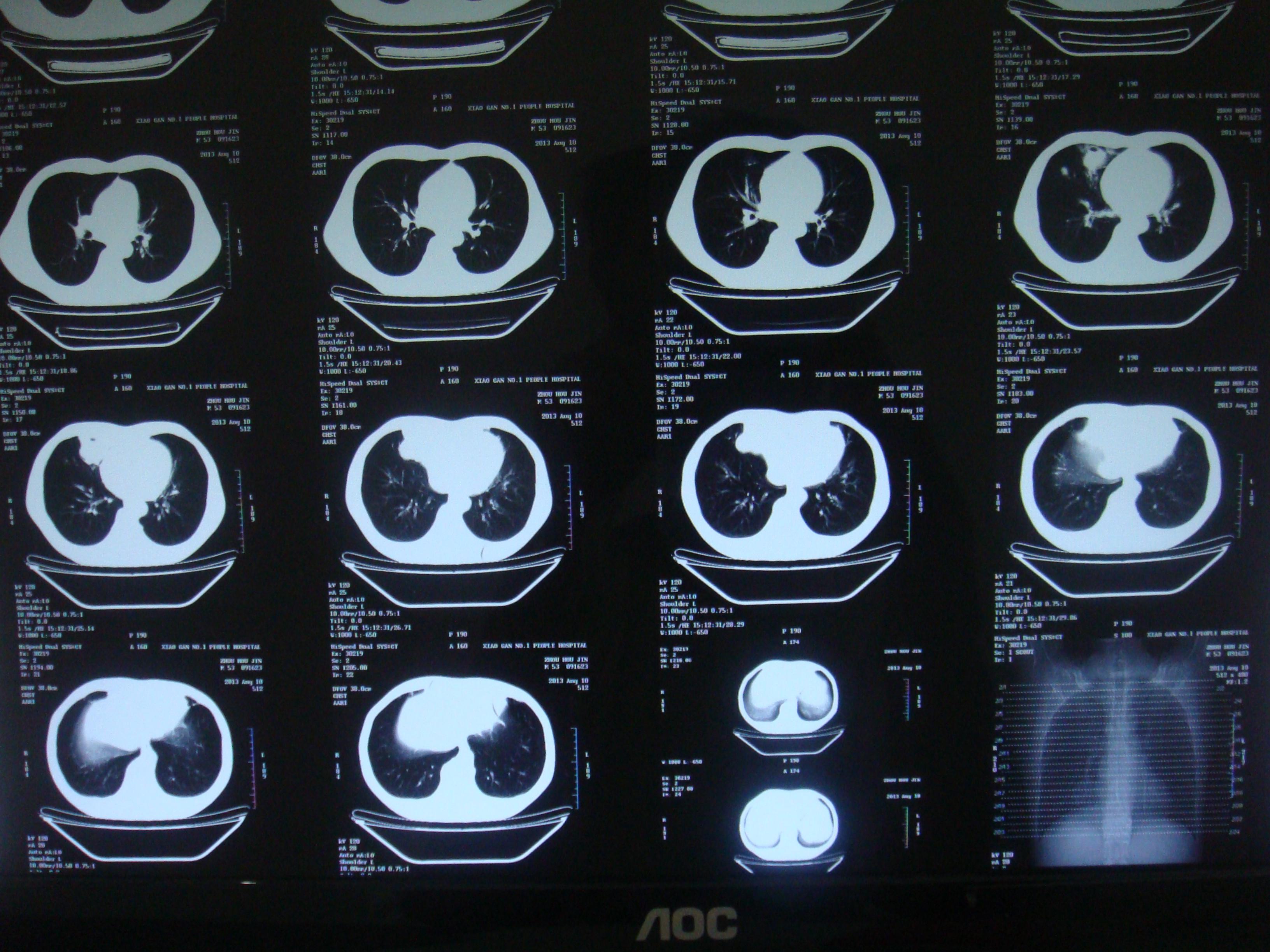 吸入性化脓性肺炎紧急求助