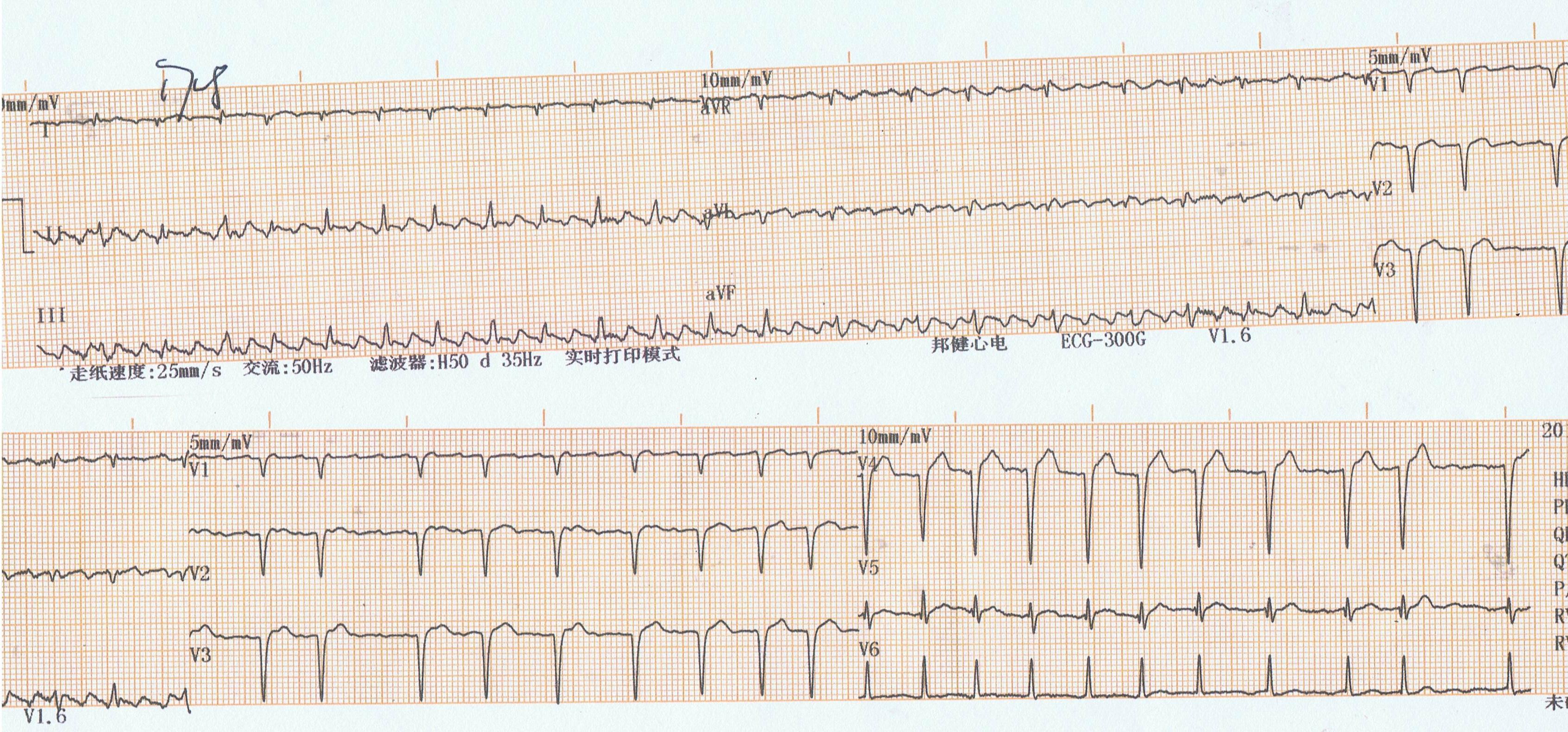 房颤房扑心电图图片