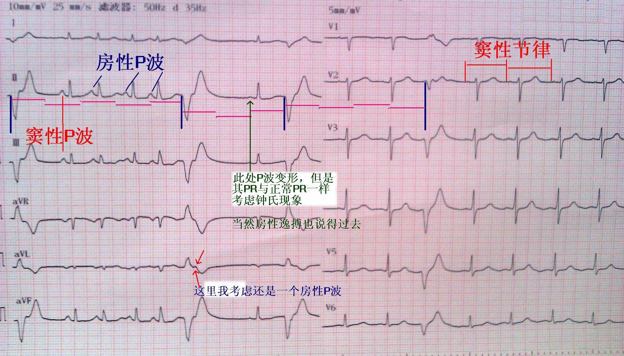 心電圖讀圖第二十三期答案已公佈請參考