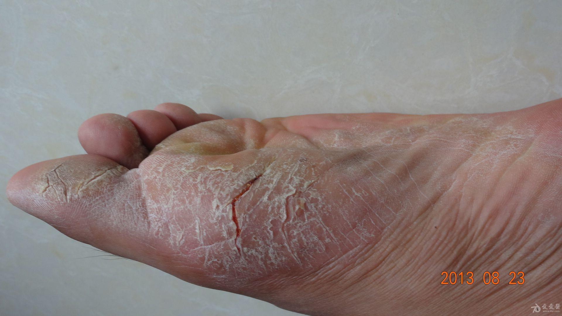 脚底常见的皮肤病图片图片