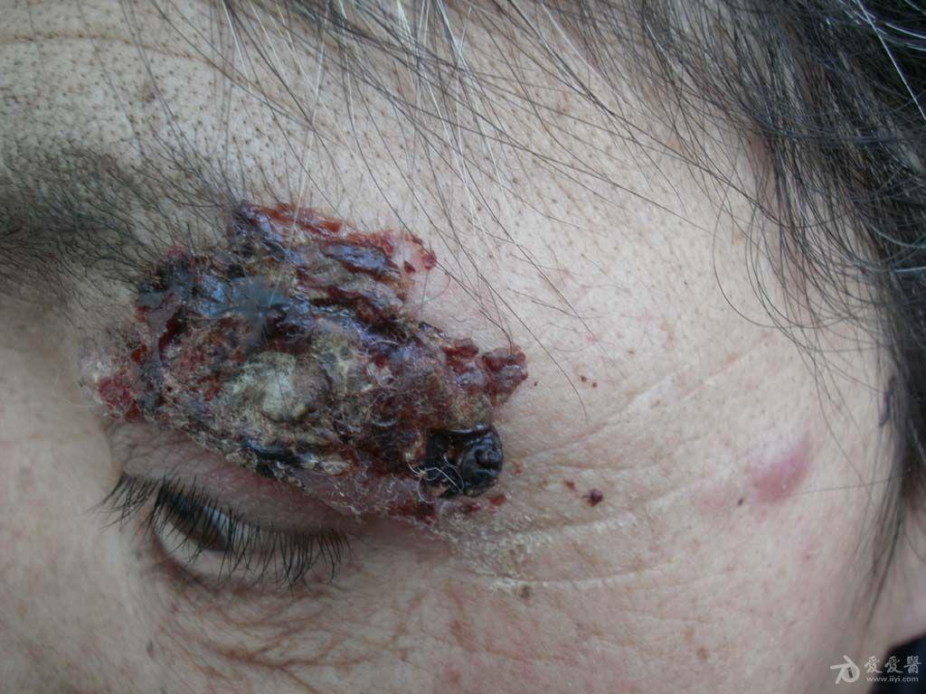 孢子丝菌病4 - 皮肤及性传播疾病讨论版 - 爱爱医医学论坛