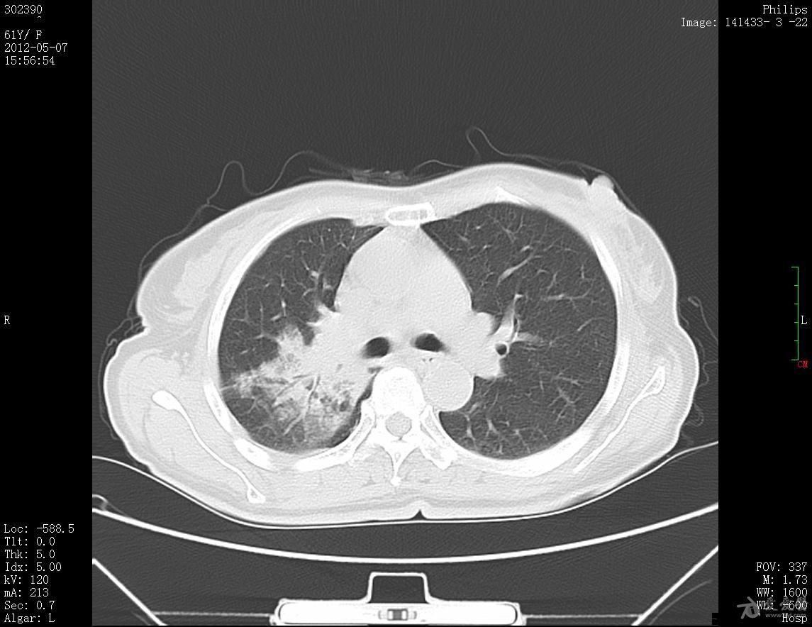 大叶性肺炎ct图片