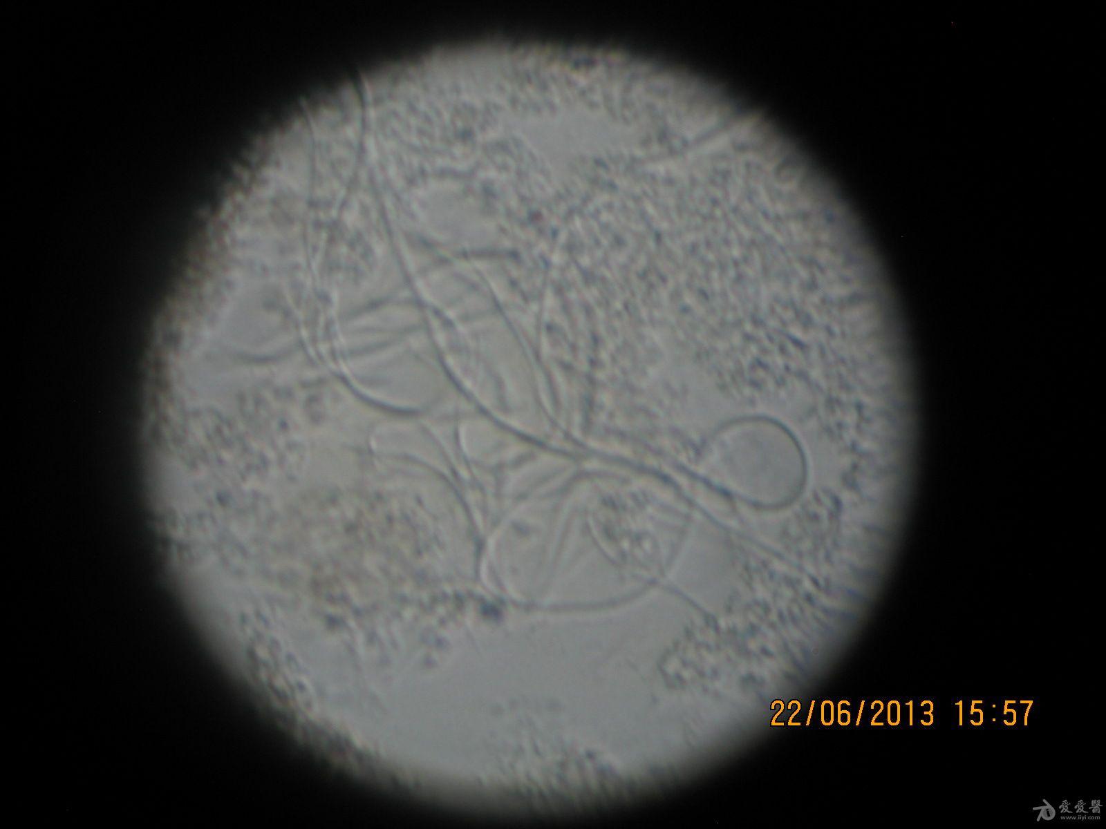 这是什么病马拉色菌毛囊炎