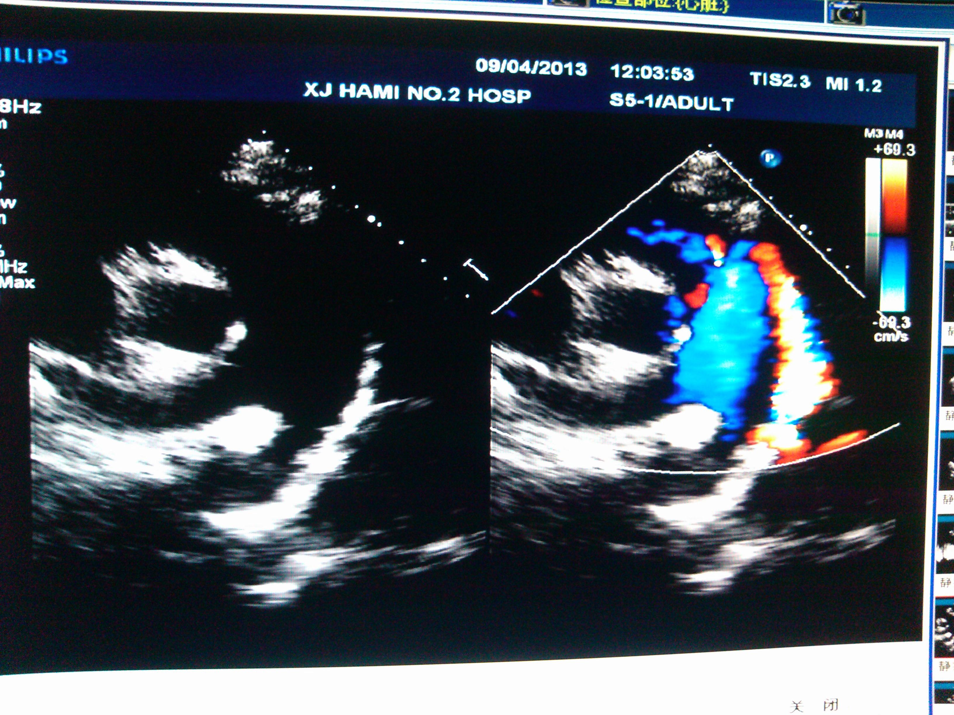 術前檢查心超 - 超聲醫學討論版 - 愛愛醫醫學論壇