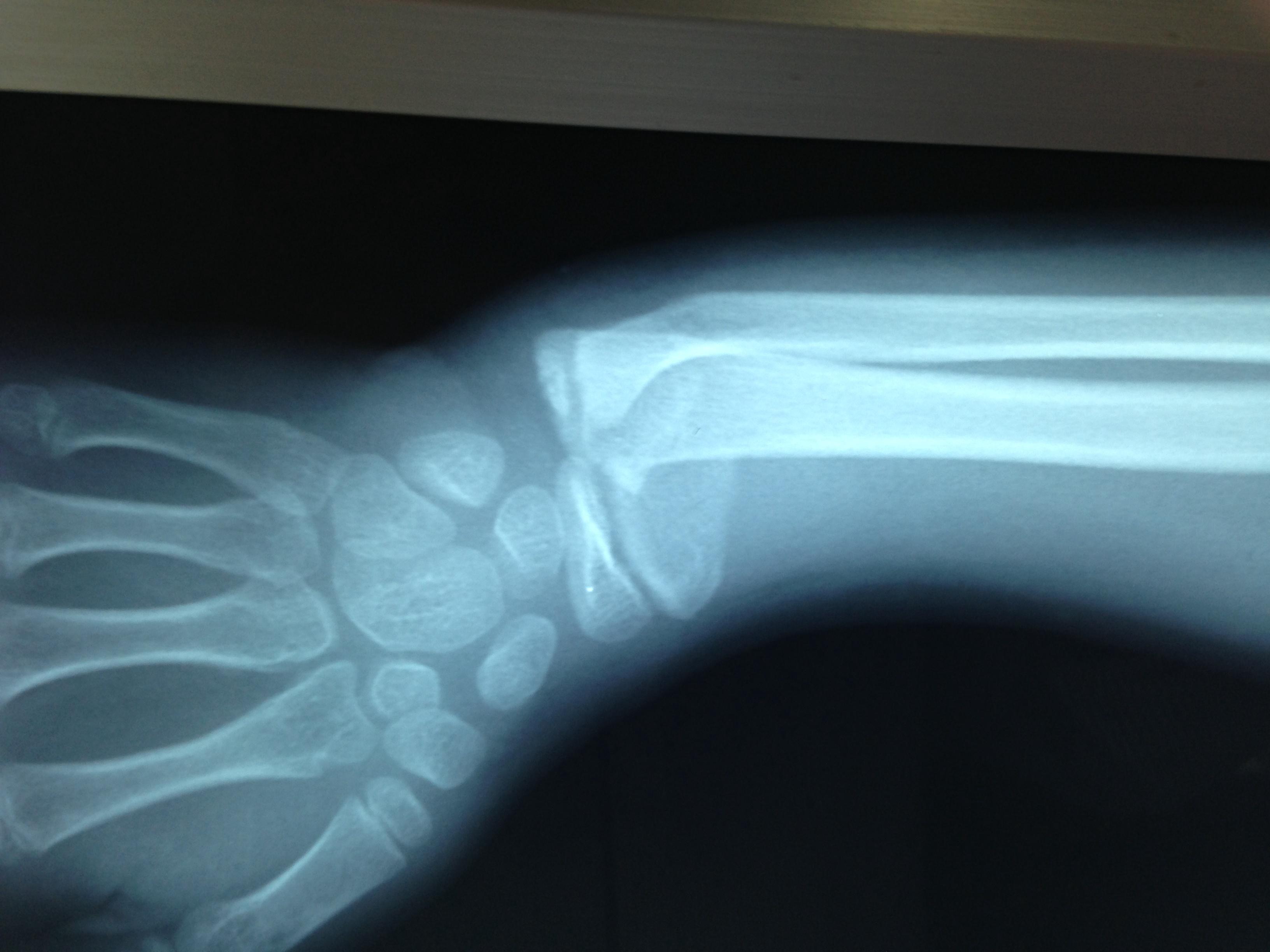 手臂骨折x光片图片