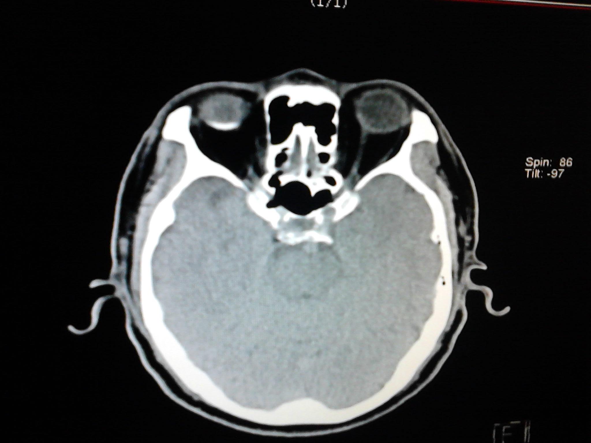 ct眼壁钙化,帮忙看看,谢谢.