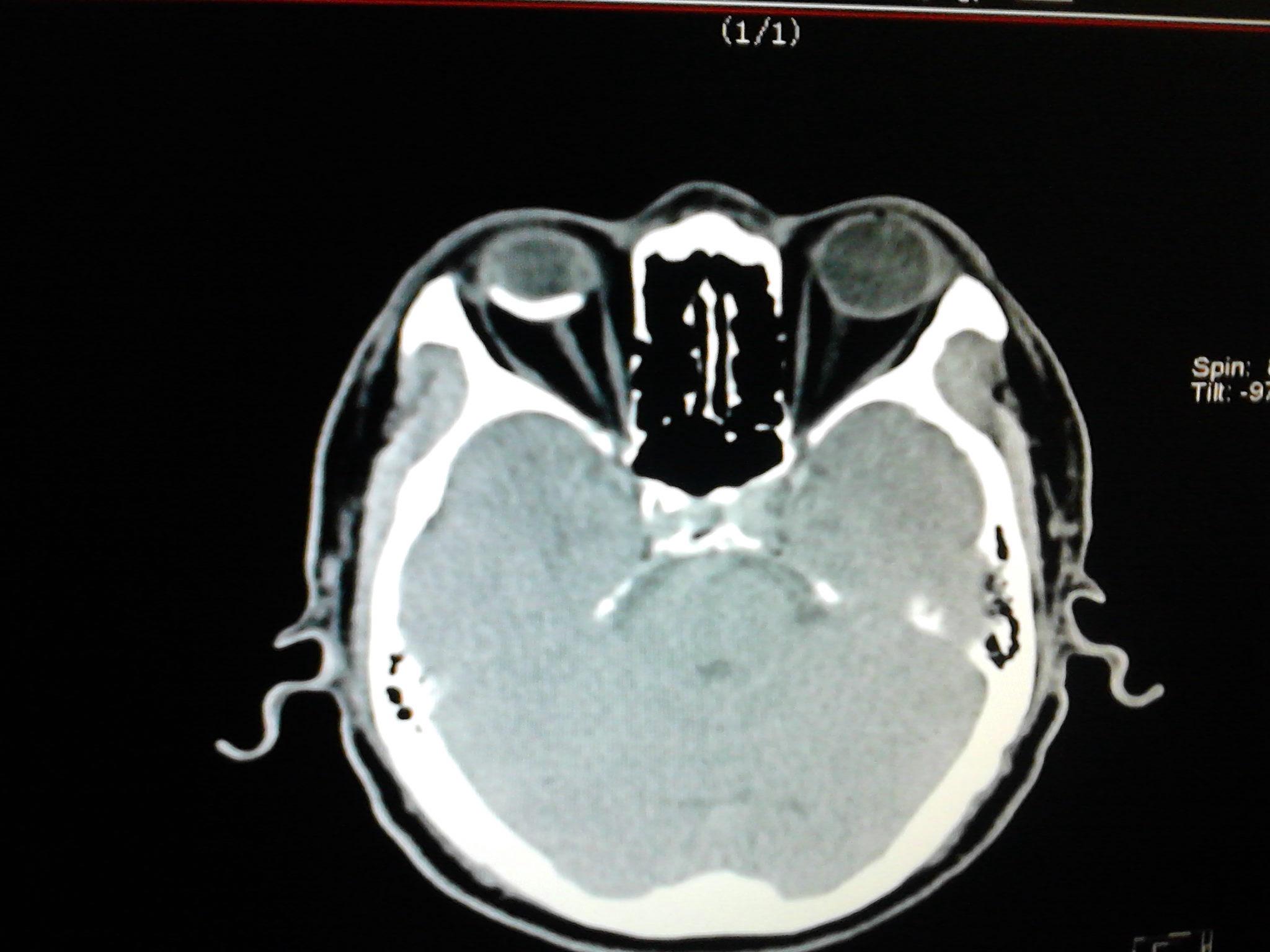 ct眼壁钙化,帮忙看看,谢谢.