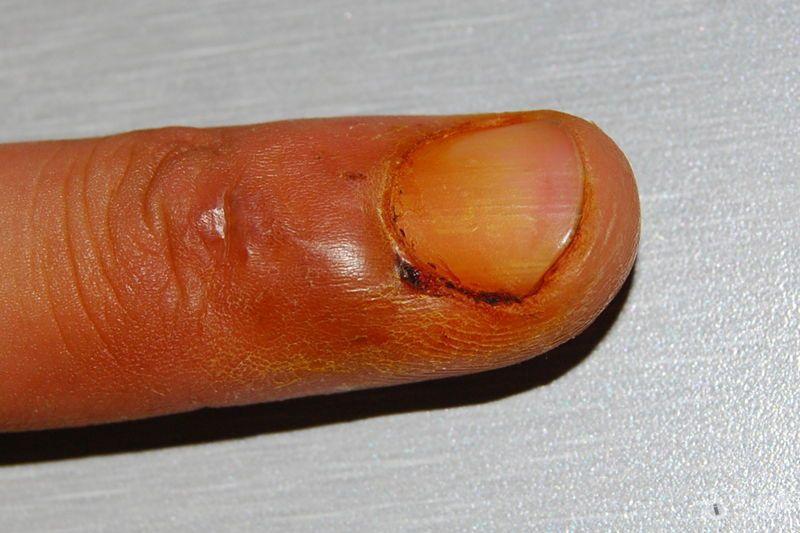 附图因外伤引起指甲根部红肿请问这应该怎么处理是否属于甲沟炎