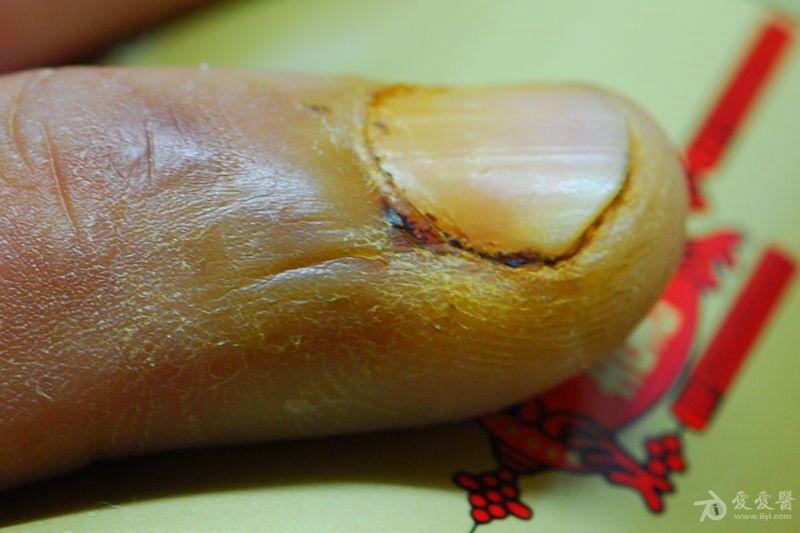 附图因外伤引起指甲根部红肿请问这应该怎么处理是否属于甲沟炎