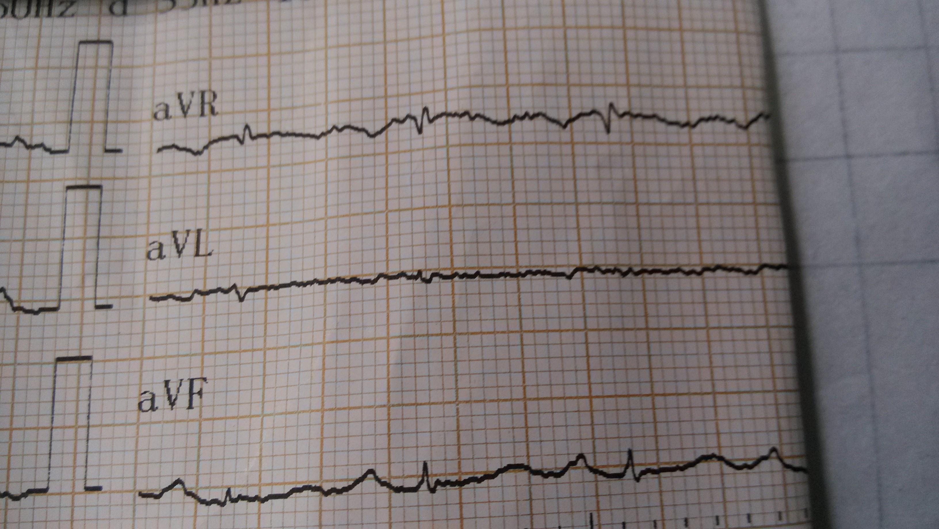 猝死病例,发病前心电图