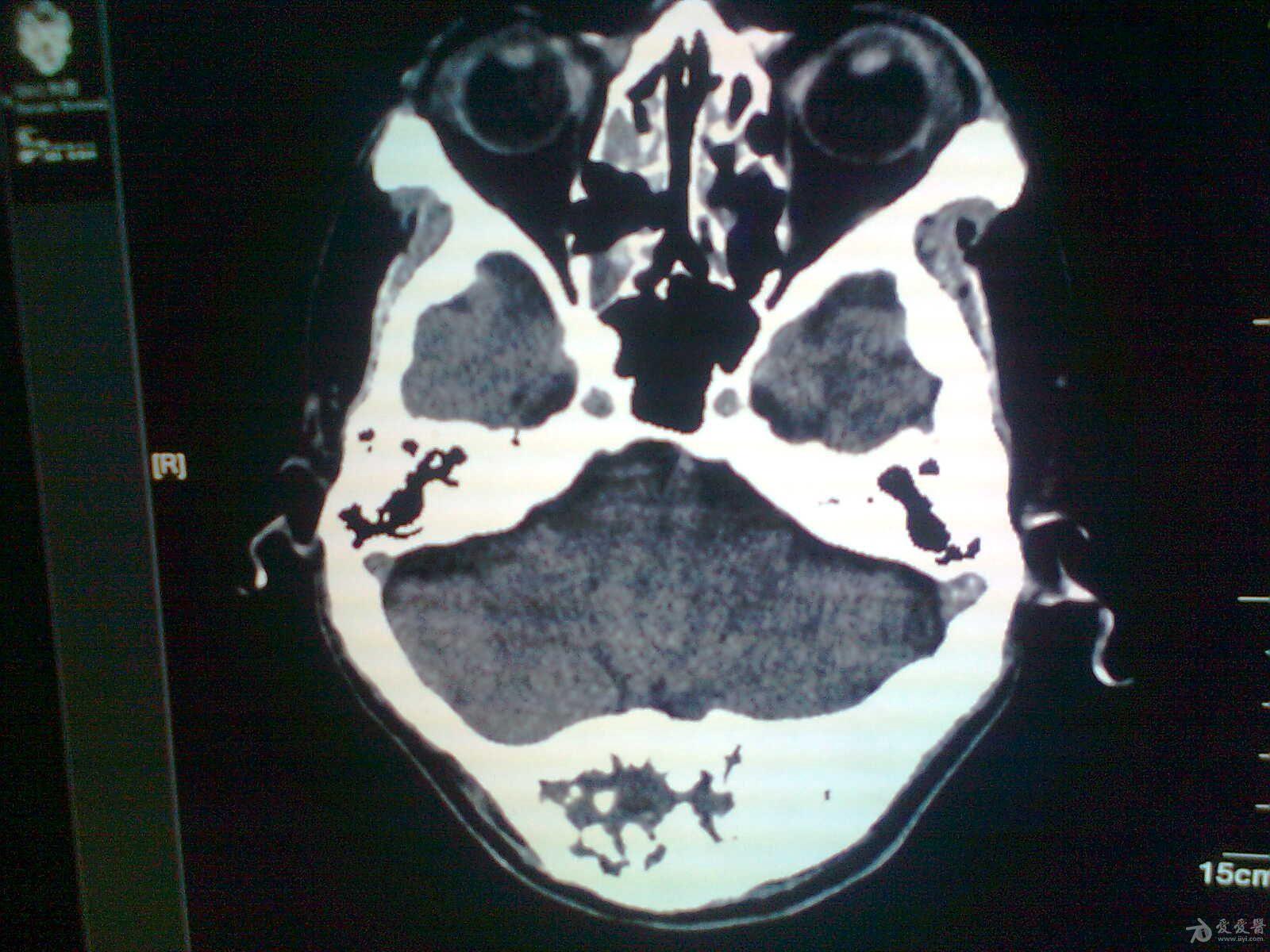 男枕骨占位病变