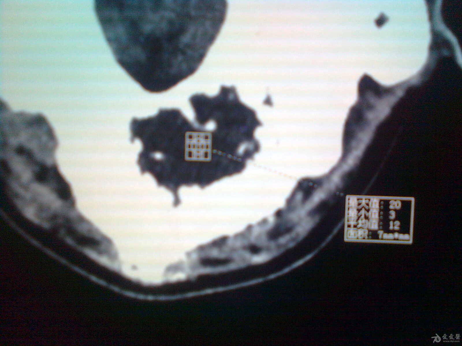 男 枕骨占位病变