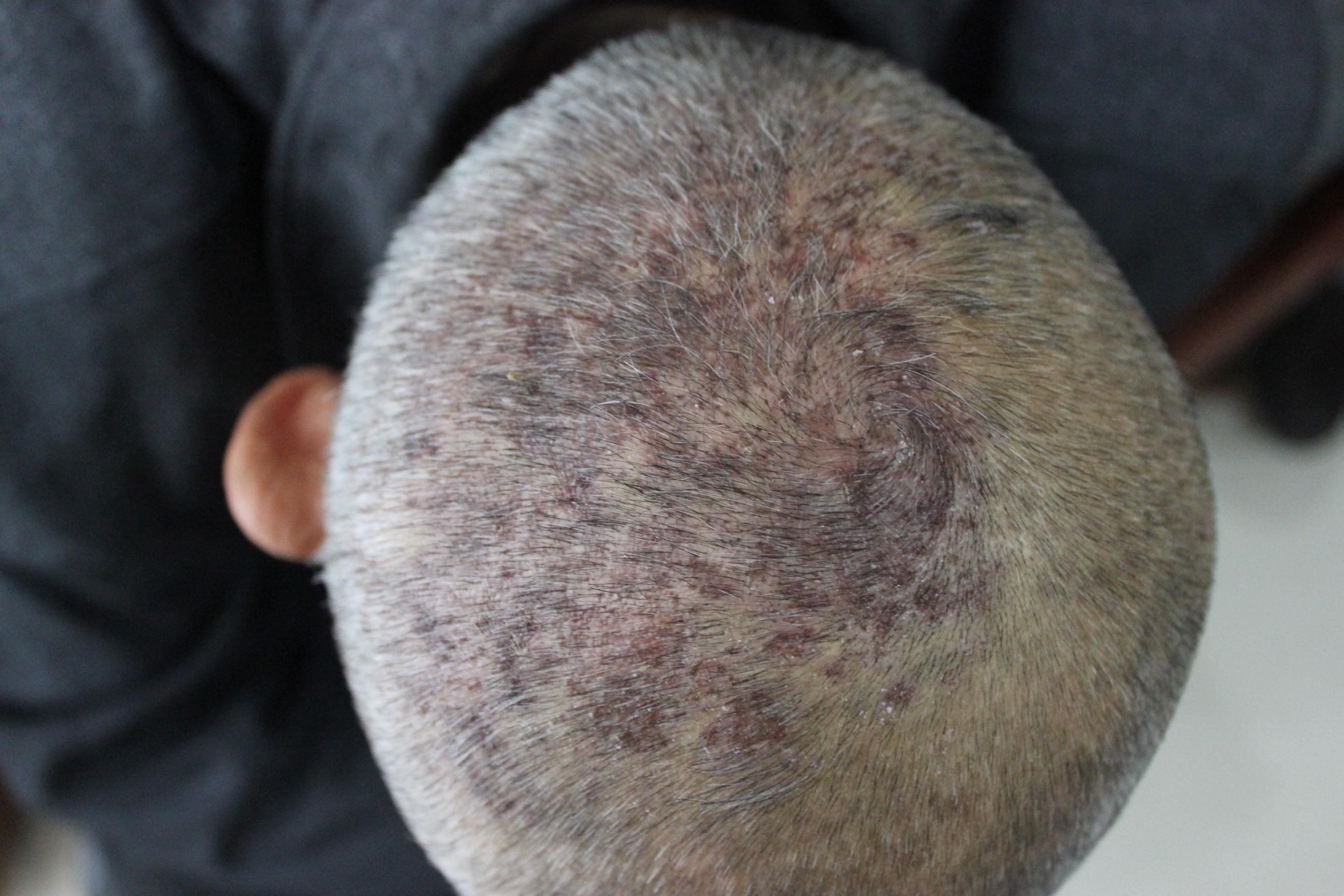 阿米替林与带状疱疹