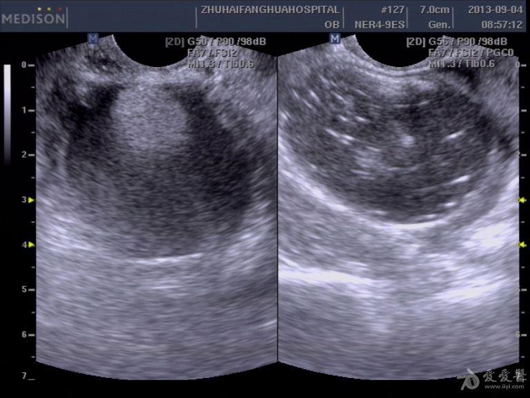 超声畸胎瘤8种声像图图片