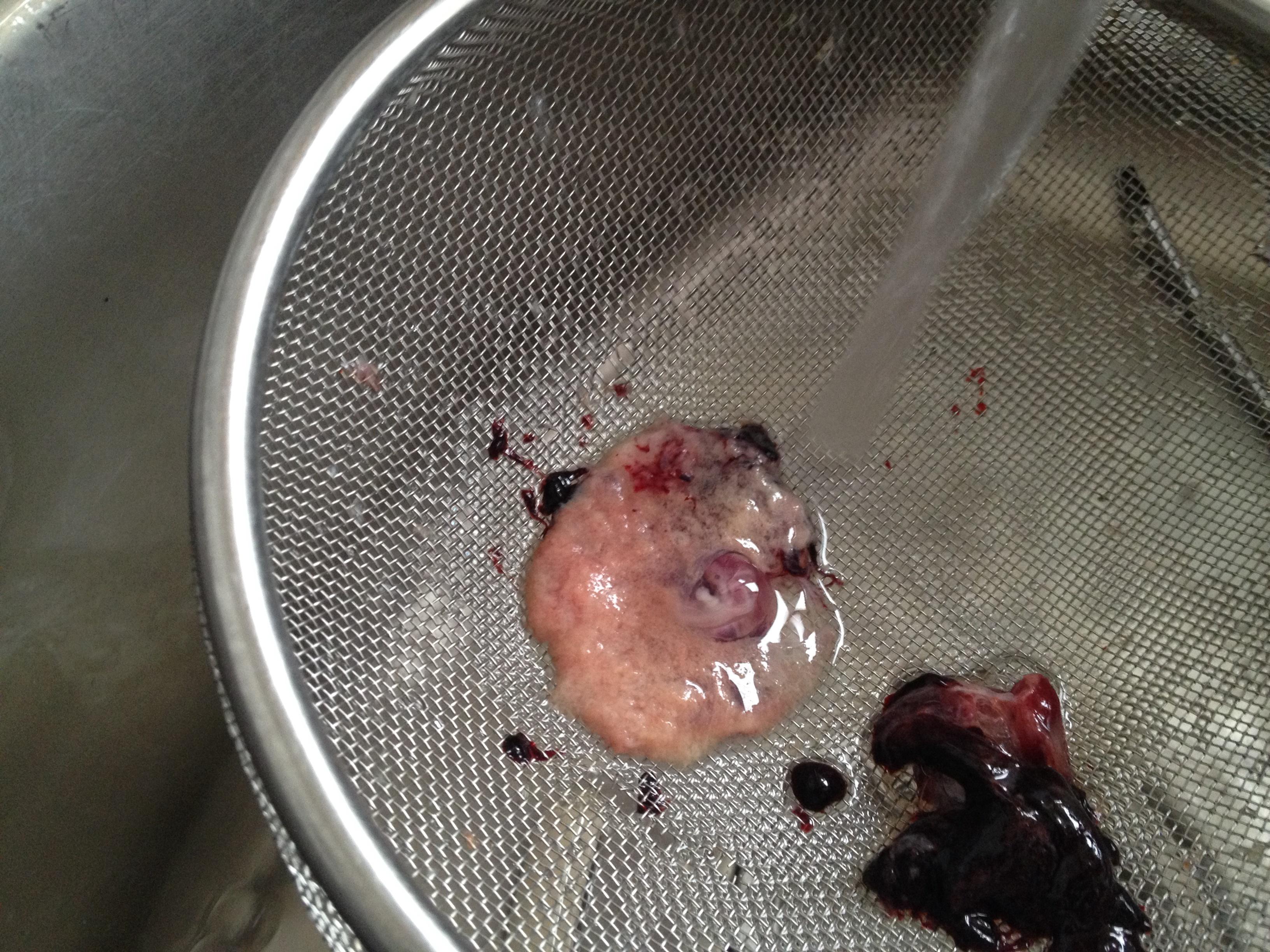 药流后的胚胎组织图片图片