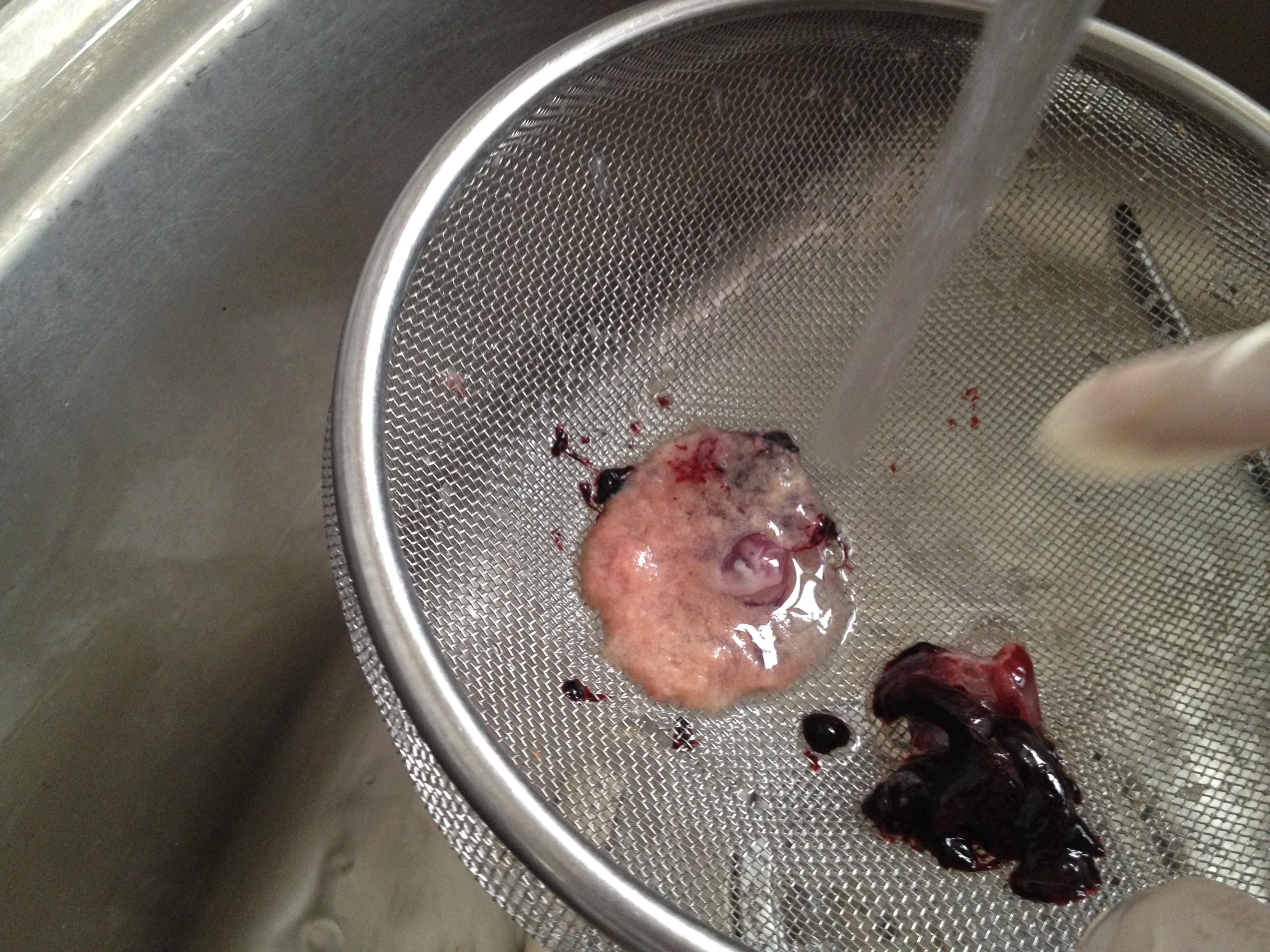 30天流产的胚胎图片图片