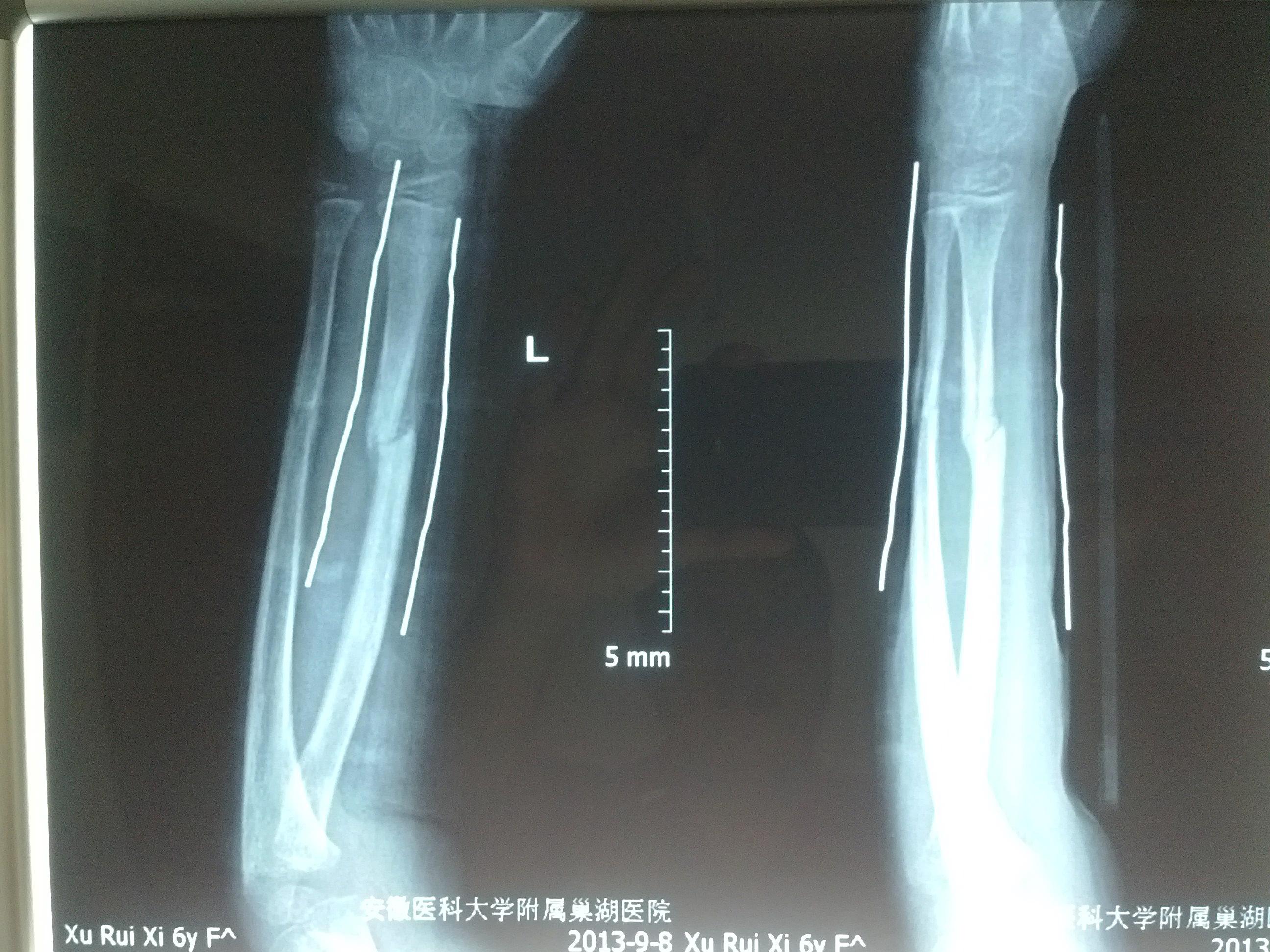 请各位老师看看此尺桡骨双骨折现状如何