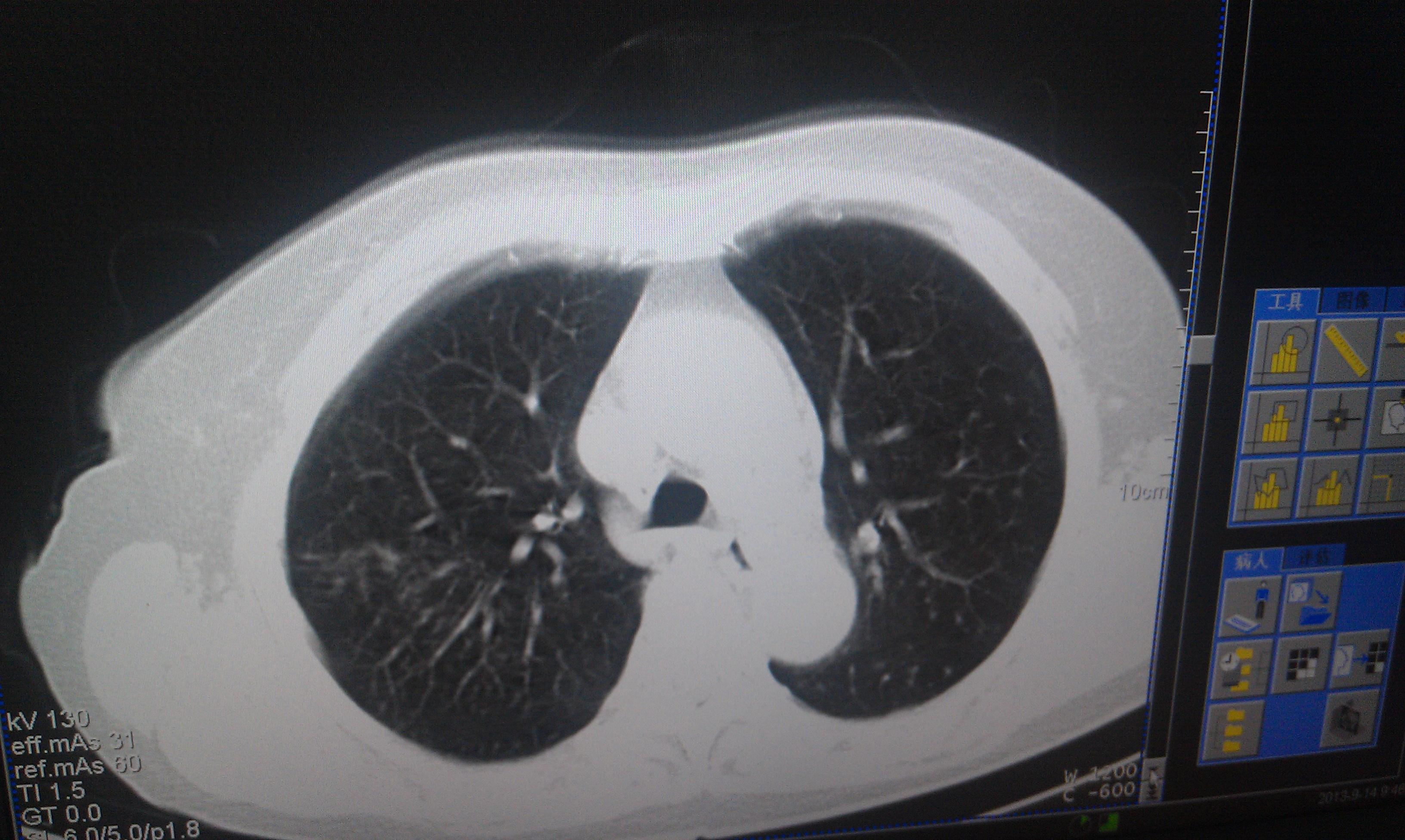 肺部ct 肺部ct醫保