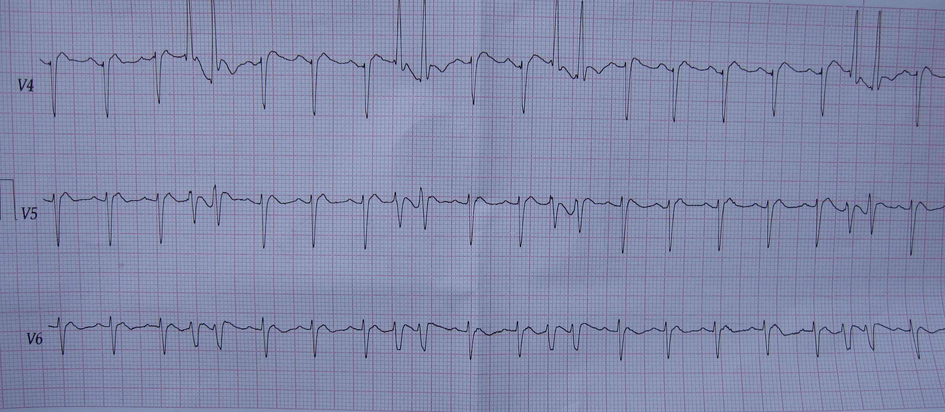 肺心病人的两次心电图检查