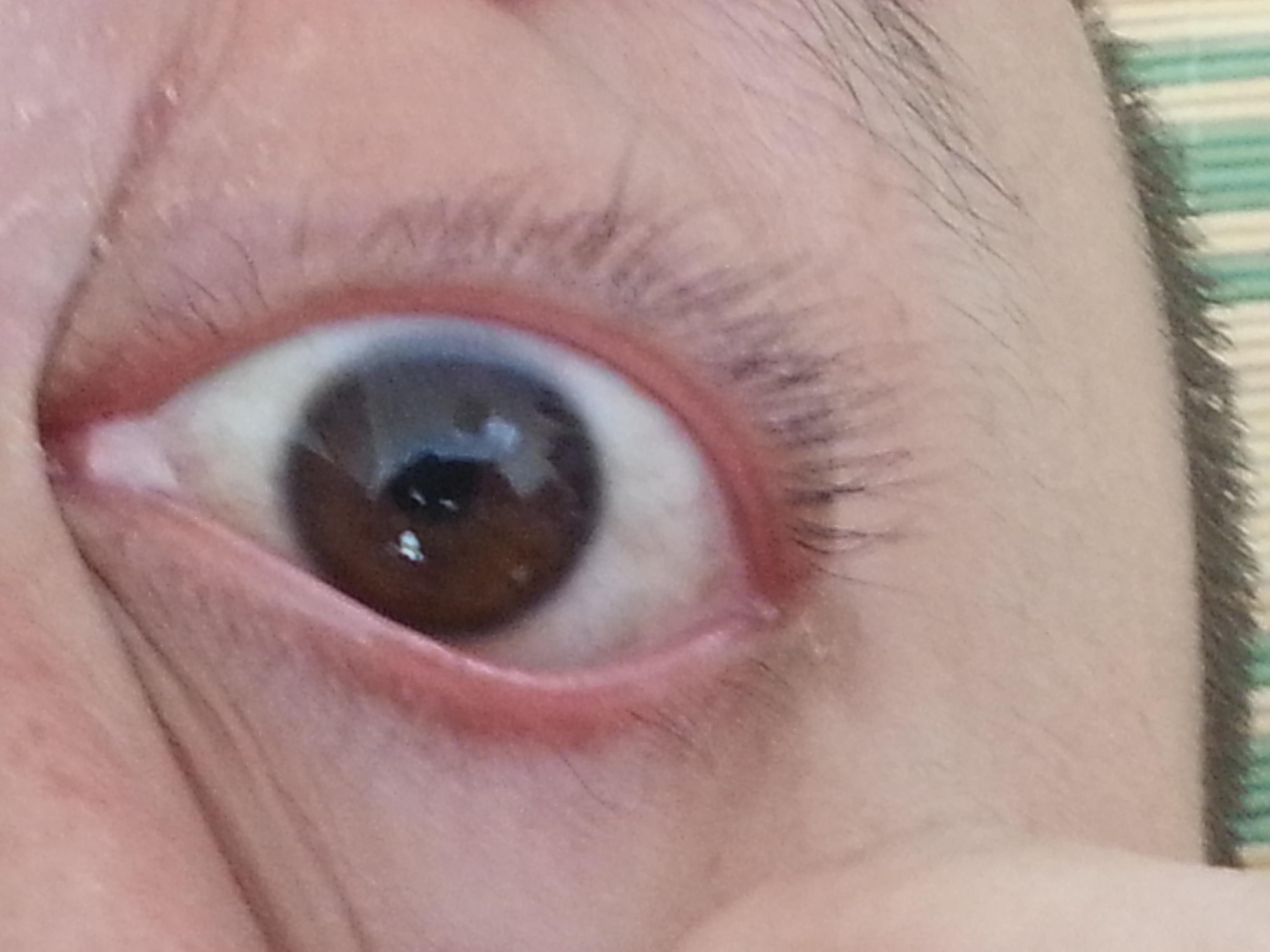 眼药水瓶口碰到了眼睛之后眼球有点疼痛