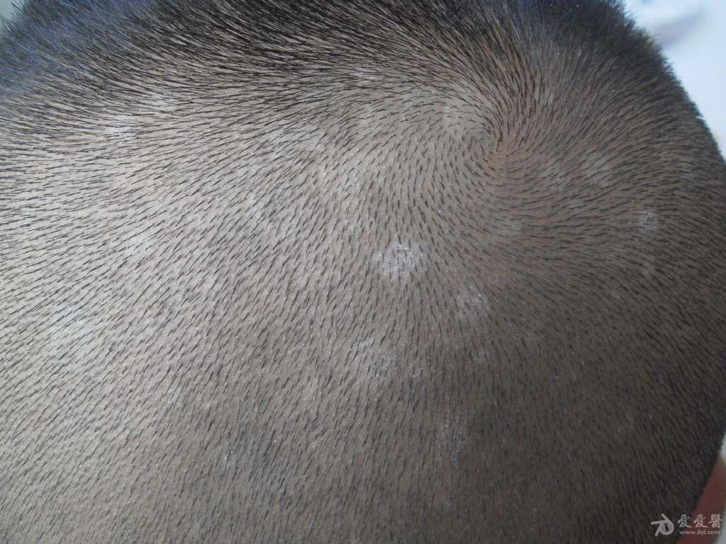12岁男孩,头皮出现豆大的白色斑片,糠屑,是头皮糠疹?