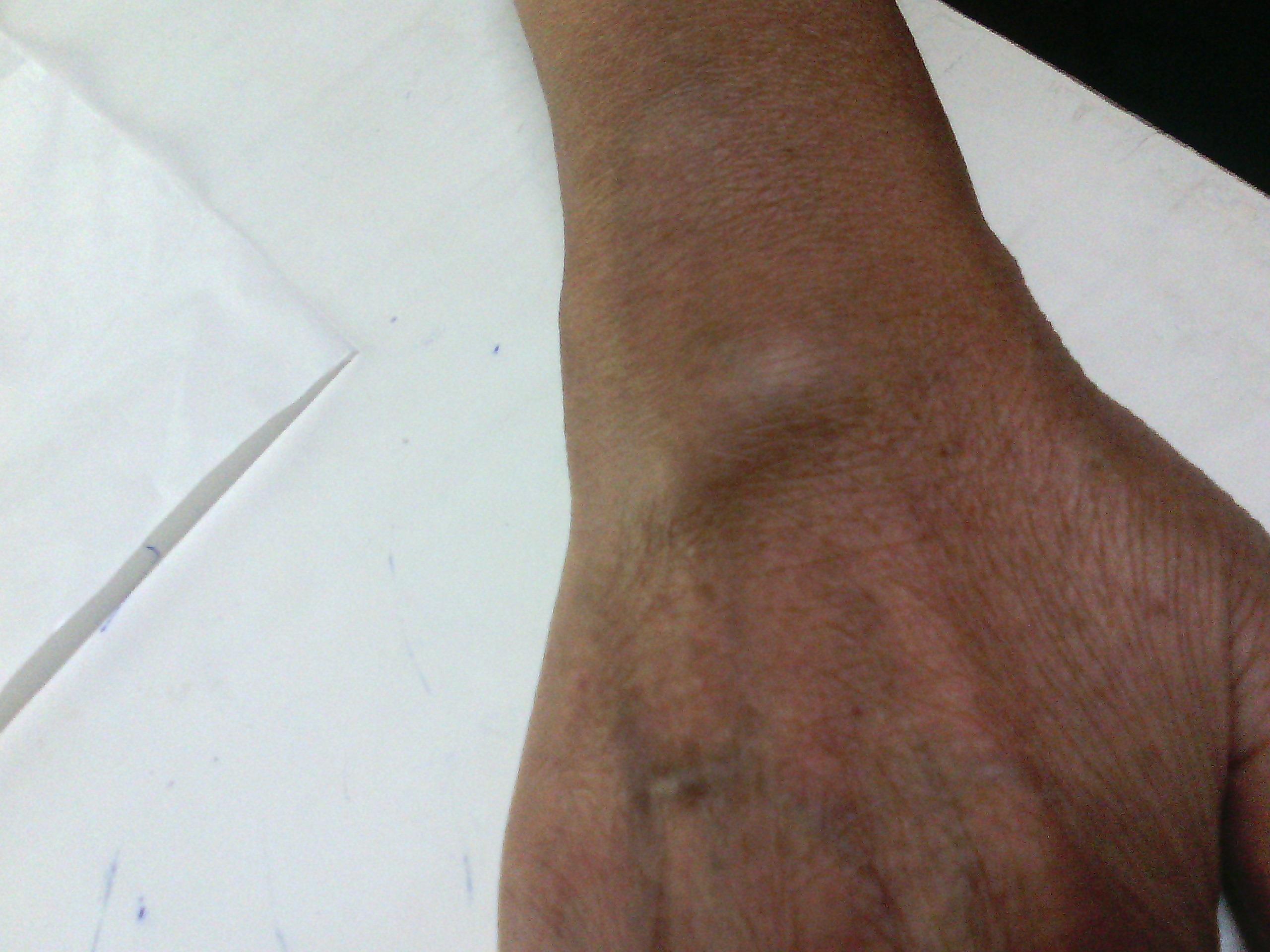 女56岁类风湿十年四五月前右腕背部见一软组织包块现拍照如下