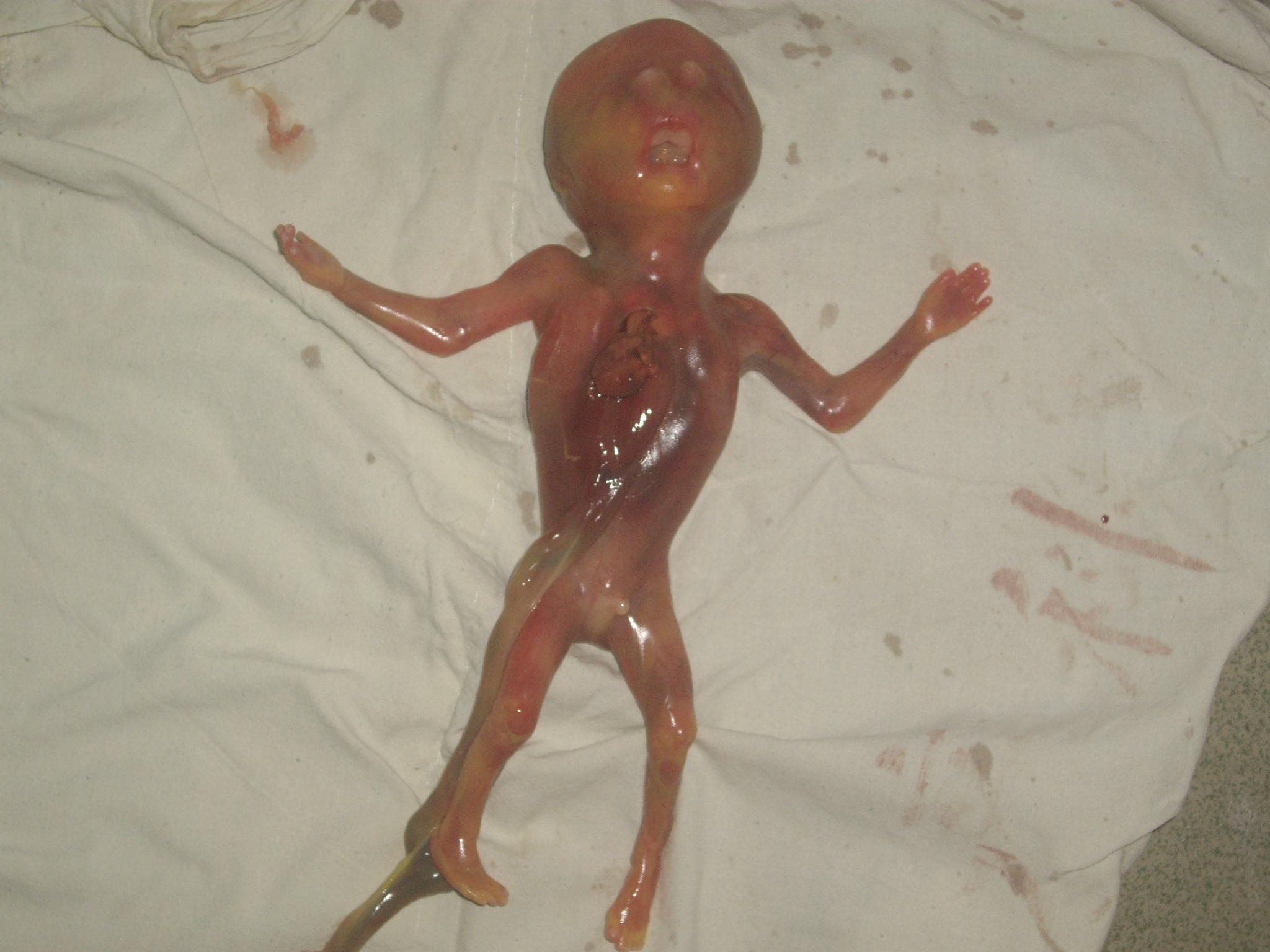 胎儿照片真人图片