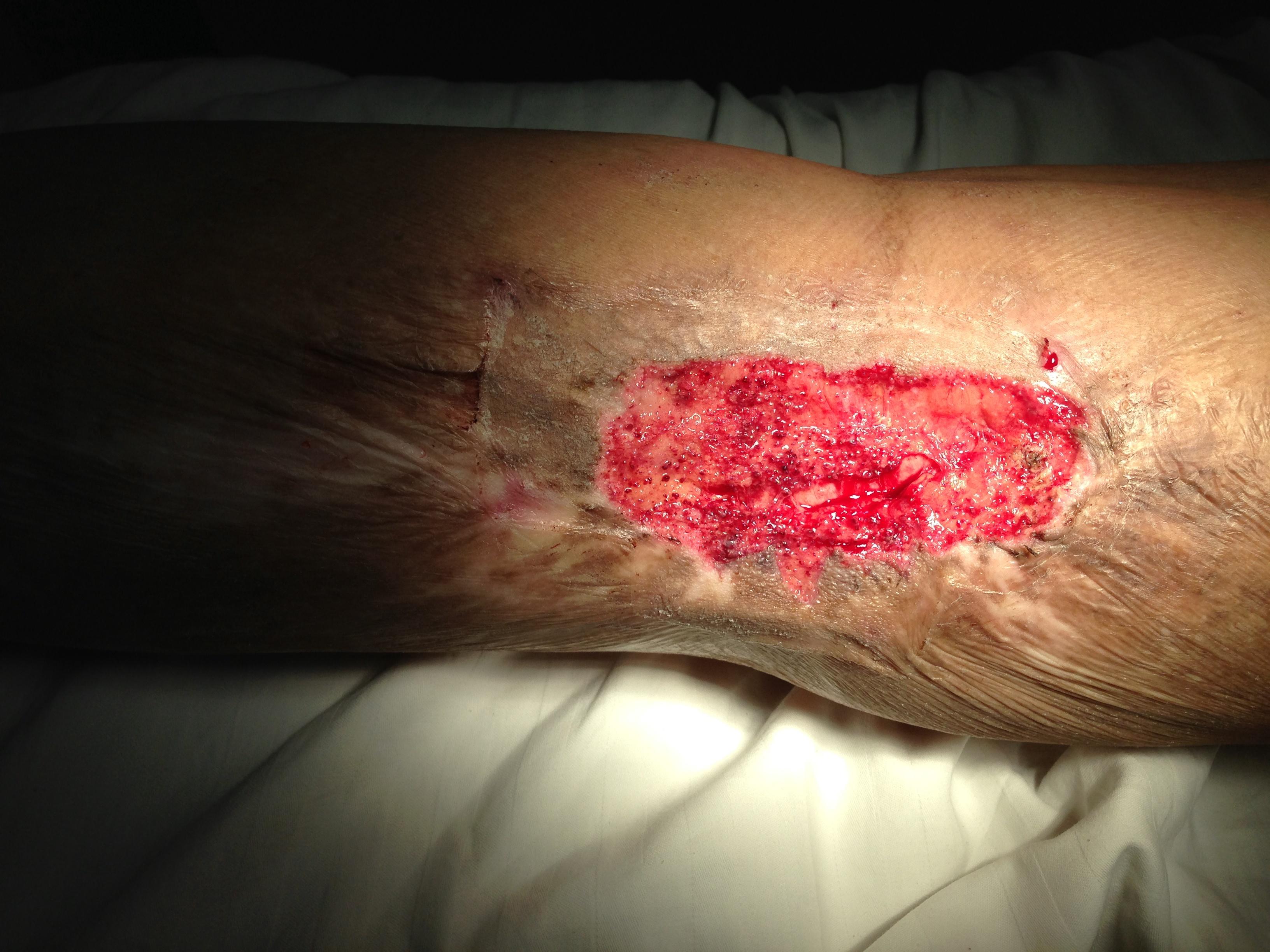 表皮移植手术后皮肤图图片