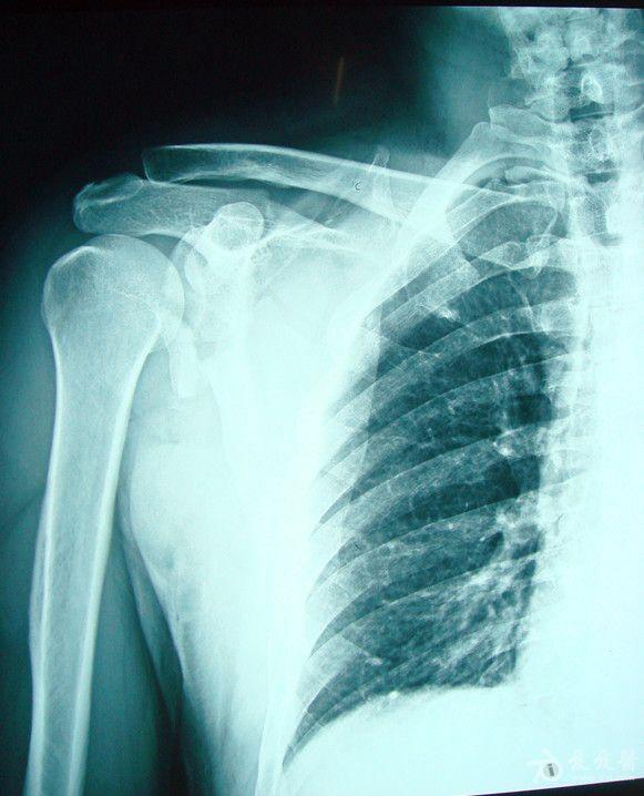肩胛骨骨折手术治疗