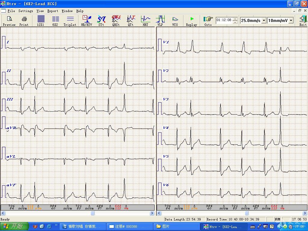 动态心电图片段双源性室早室速