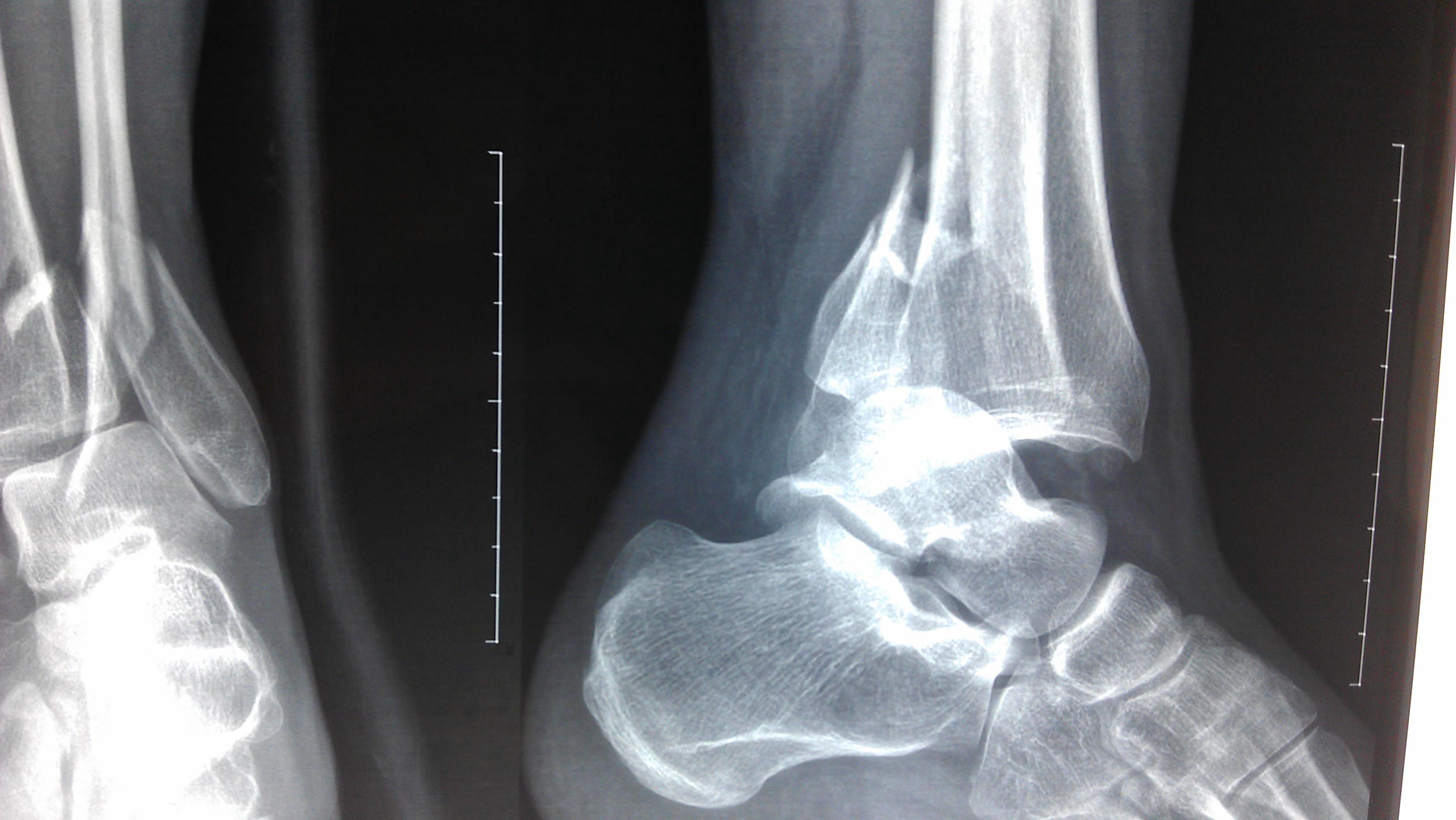 三踝骨折并踝关节脱位,手术效果怎么样?还有更好的方法吗?