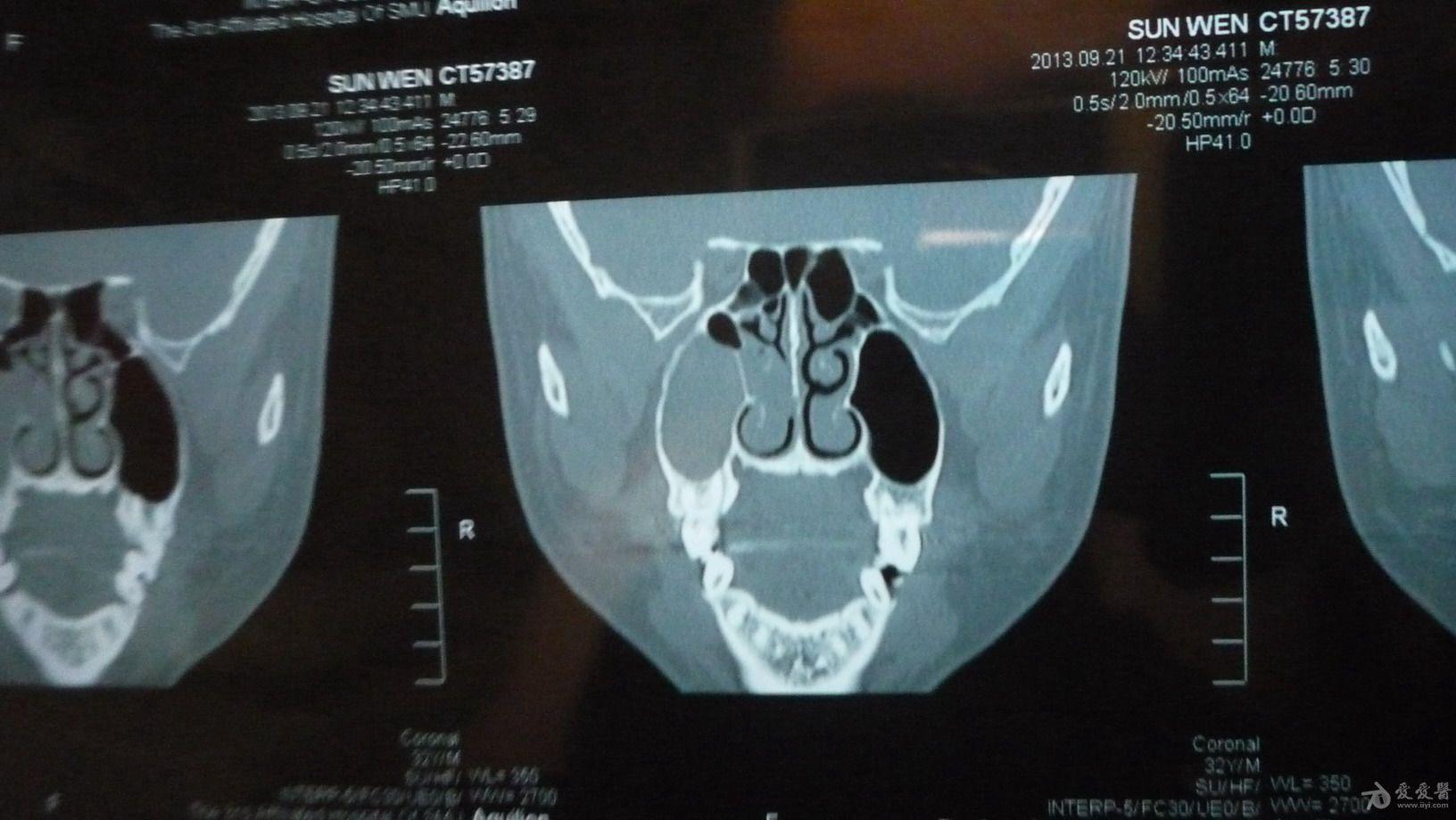 上颌窦解剖图CT图片