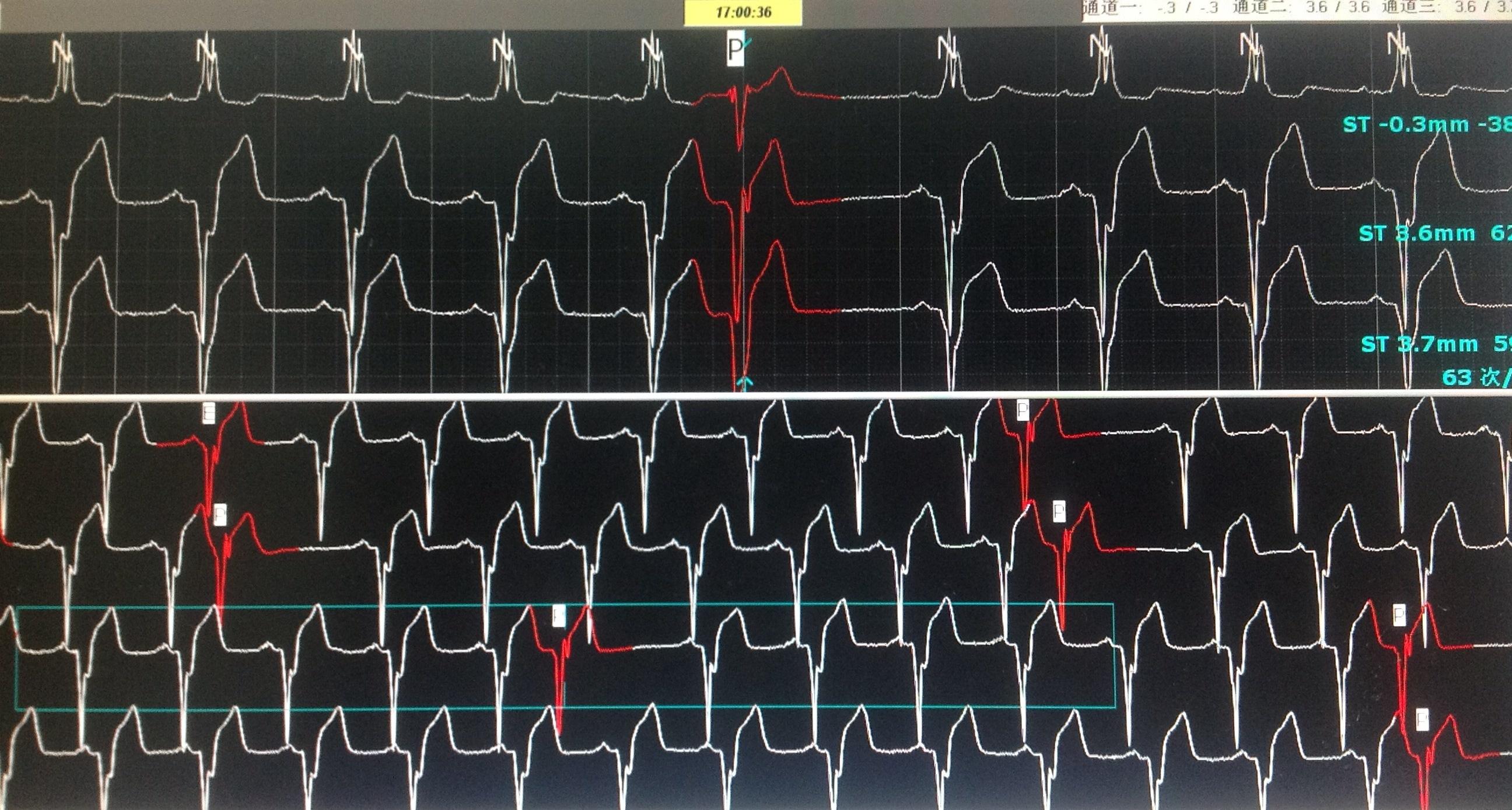 动态心电图三通道请老师帮我分析下