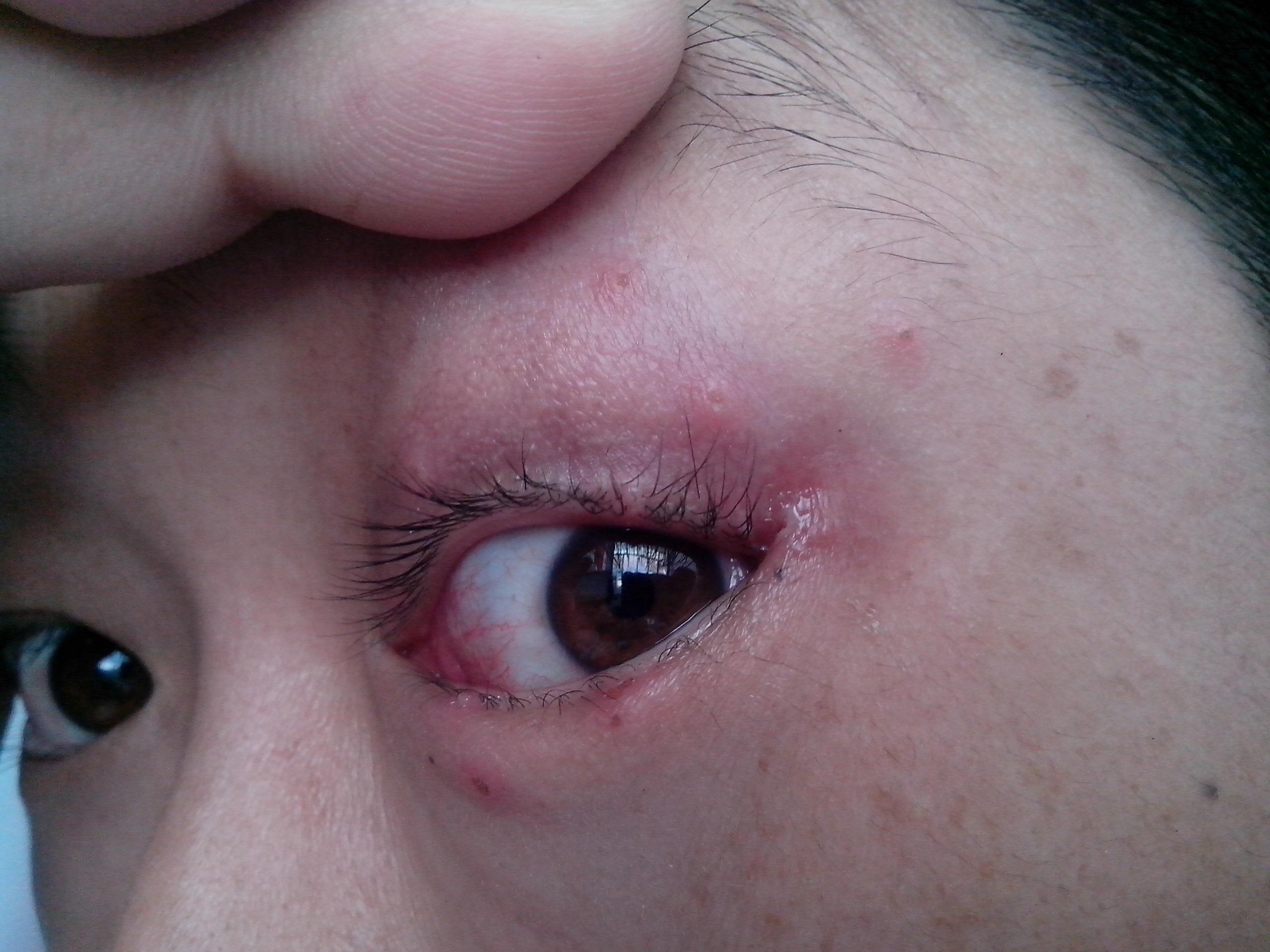 病毒性眼睑炎症状图片图片