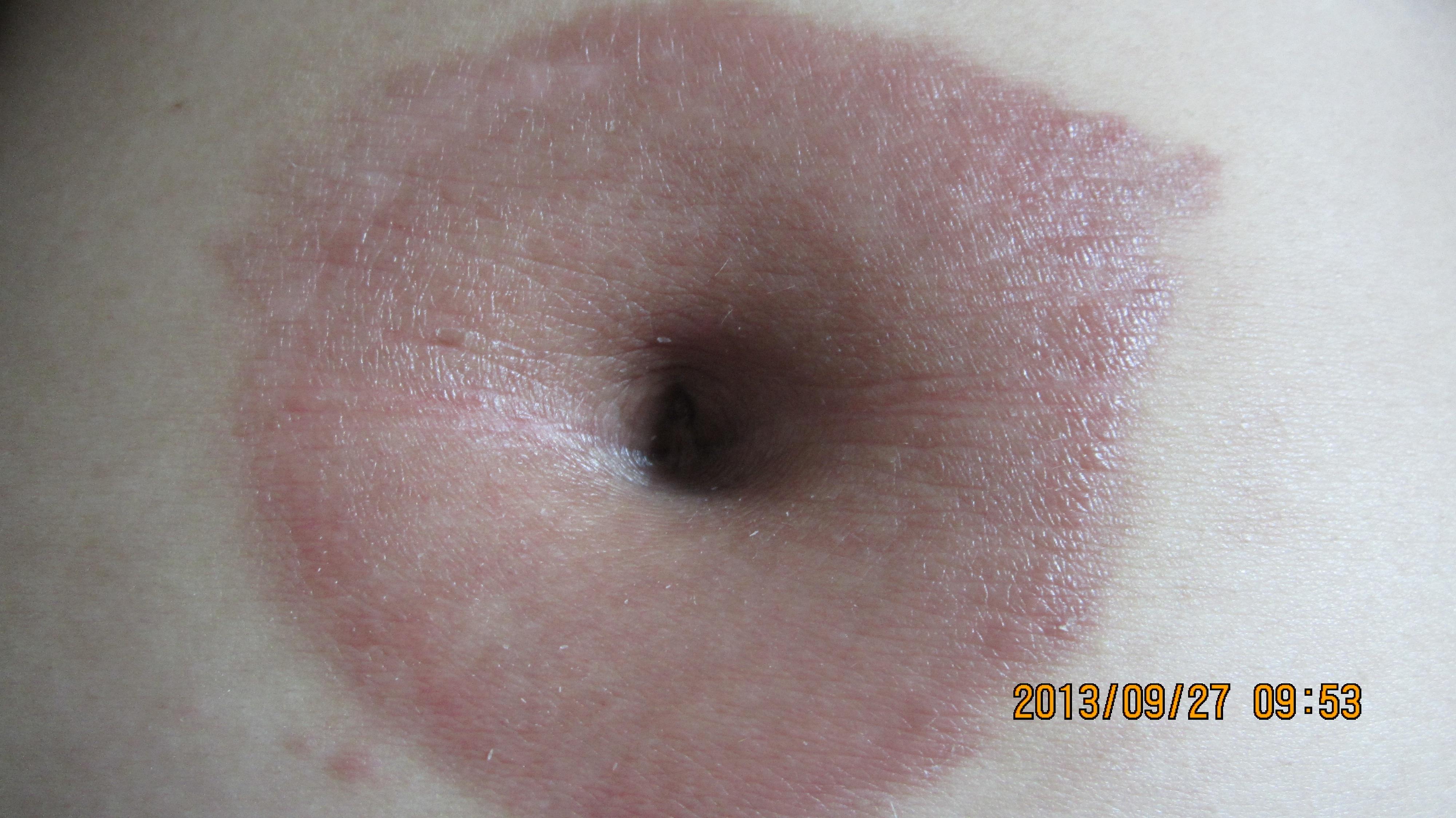 大人脐炎的症状图片图片